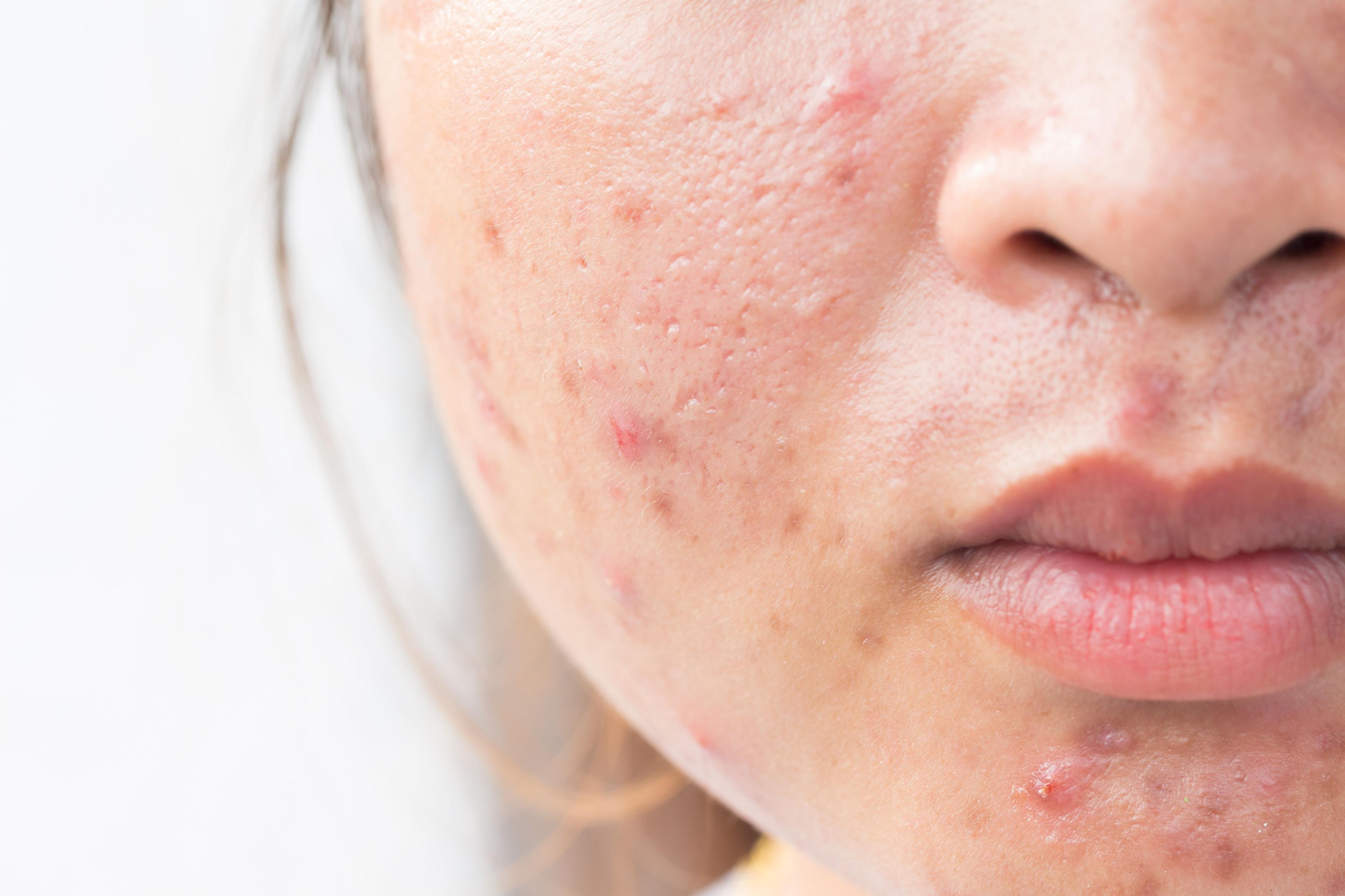 adult acne