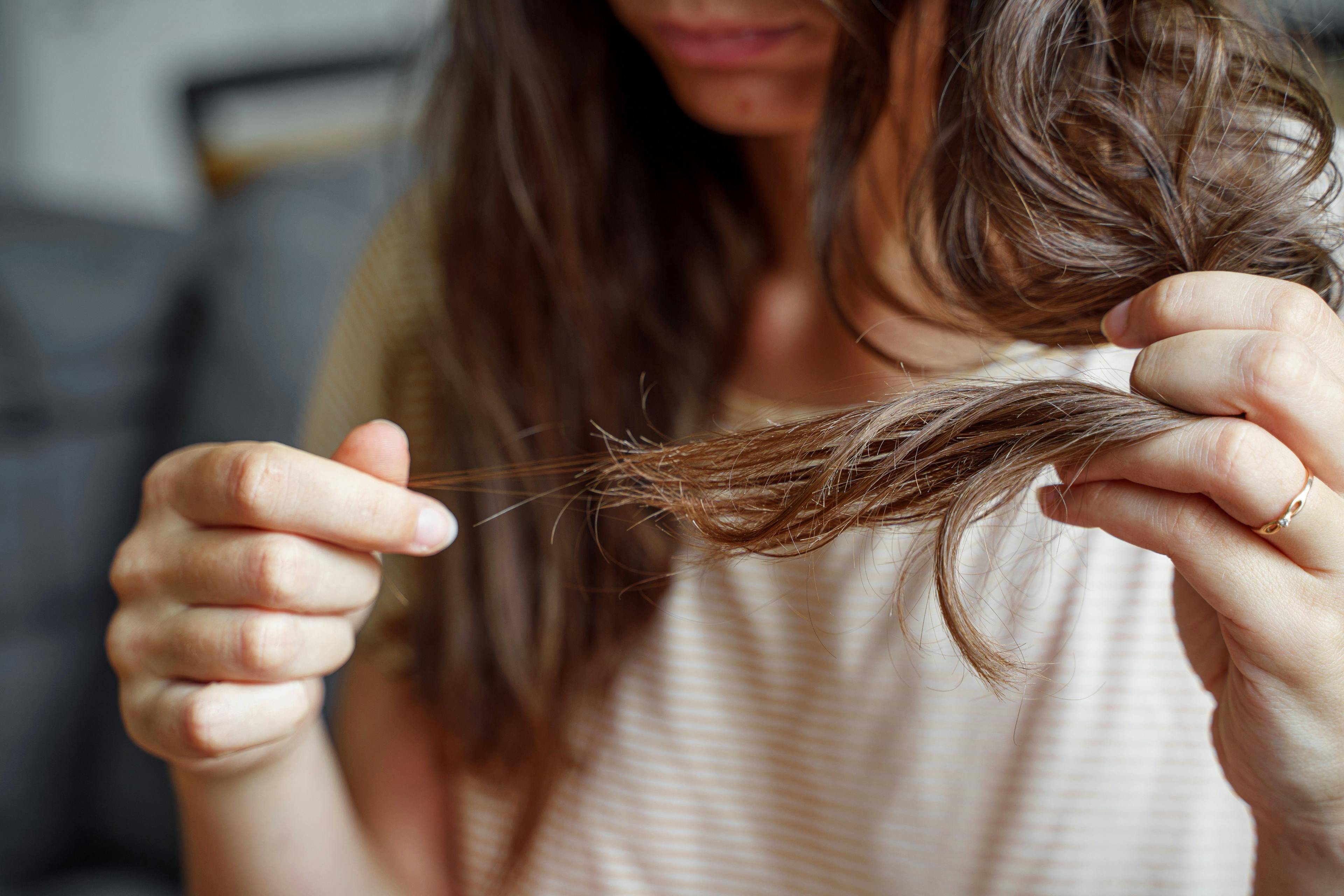 Patient with hair loss | Image Credit: © troyanphoto - stock.adobe.com