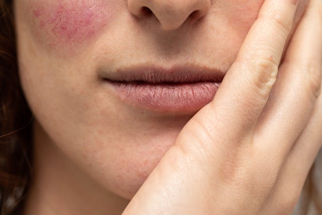 Adding Oral Tranexamic Acid to Traditional Therapies Led to Rapid Improvements in Papulopustular Rosacea