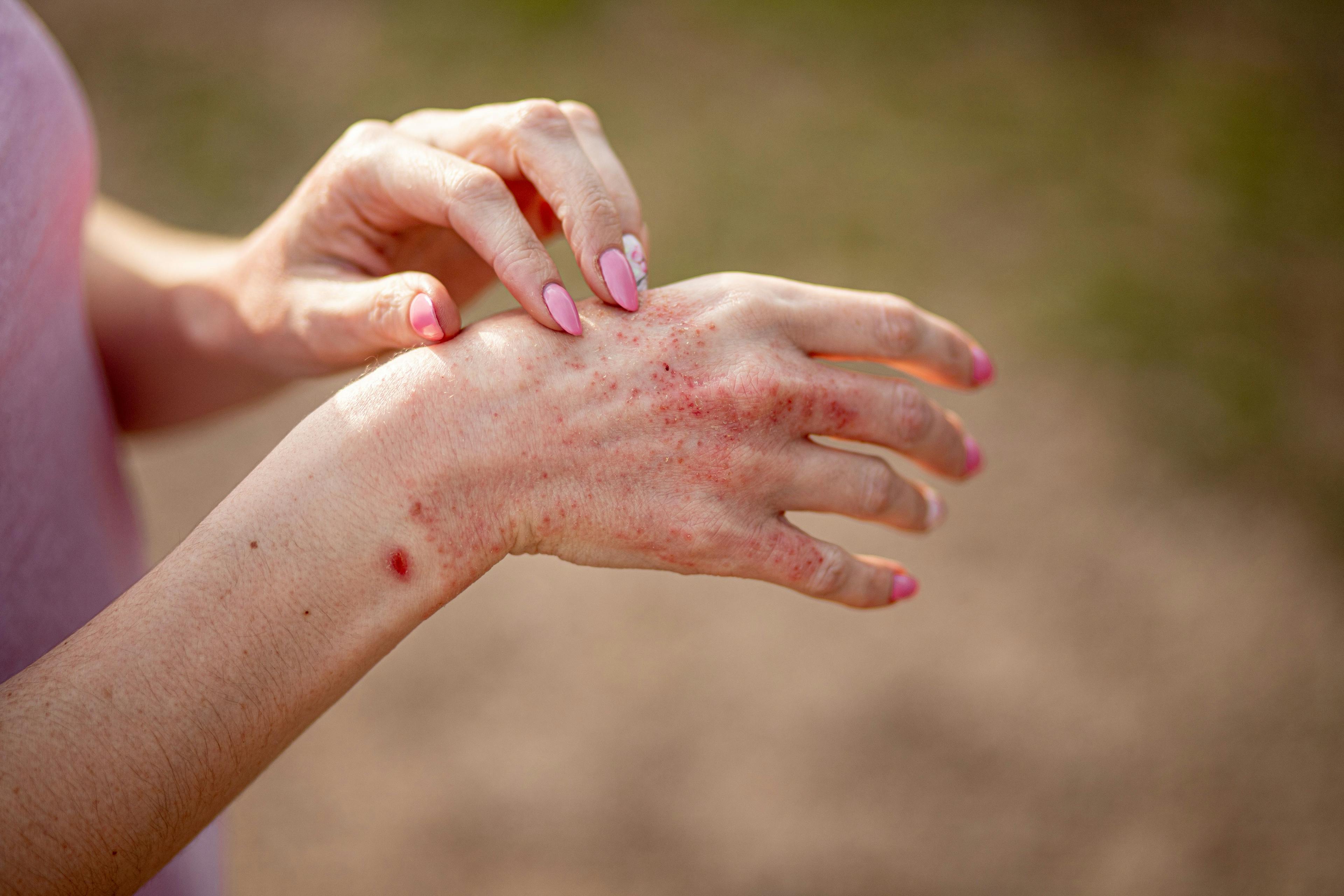 Patient with AD on hands | Image Credit: © InfiniteStudio - stock.adobe.com