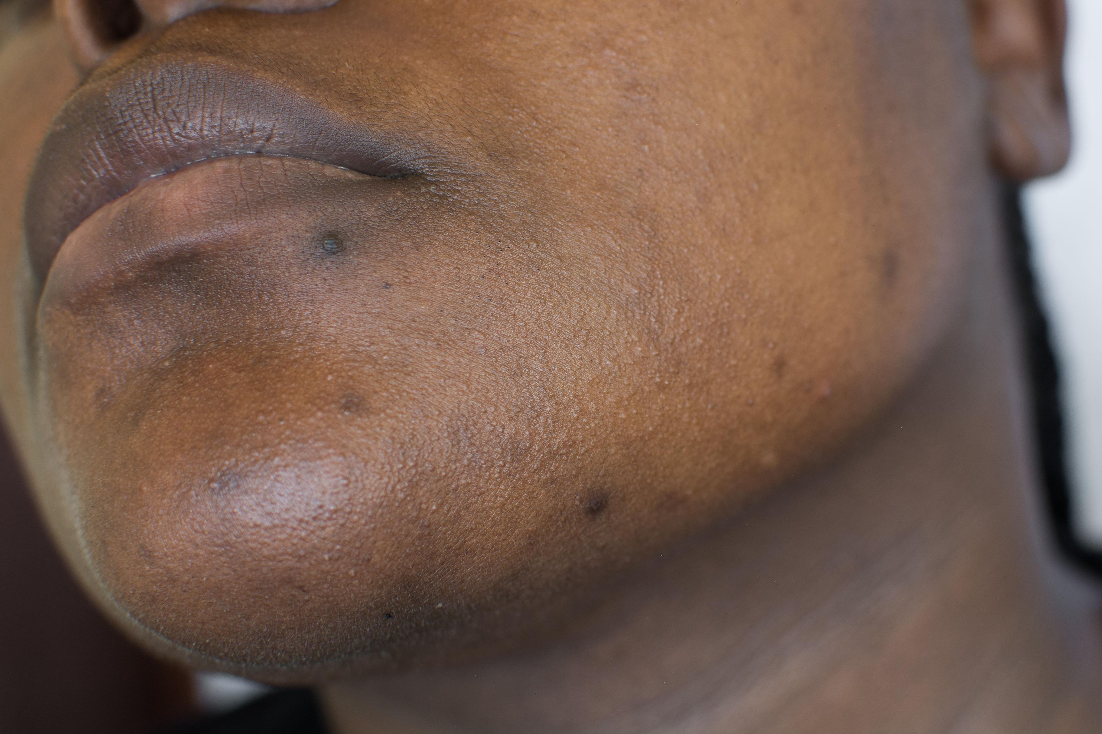 Gaps in Post-Inflammatory Hyperpigmentation Research for Skin of Color