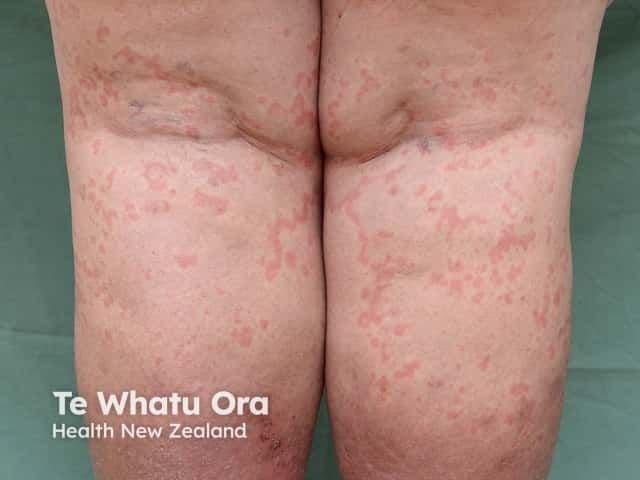 Patient with CSU | Image Credit: © dermnetnz.org