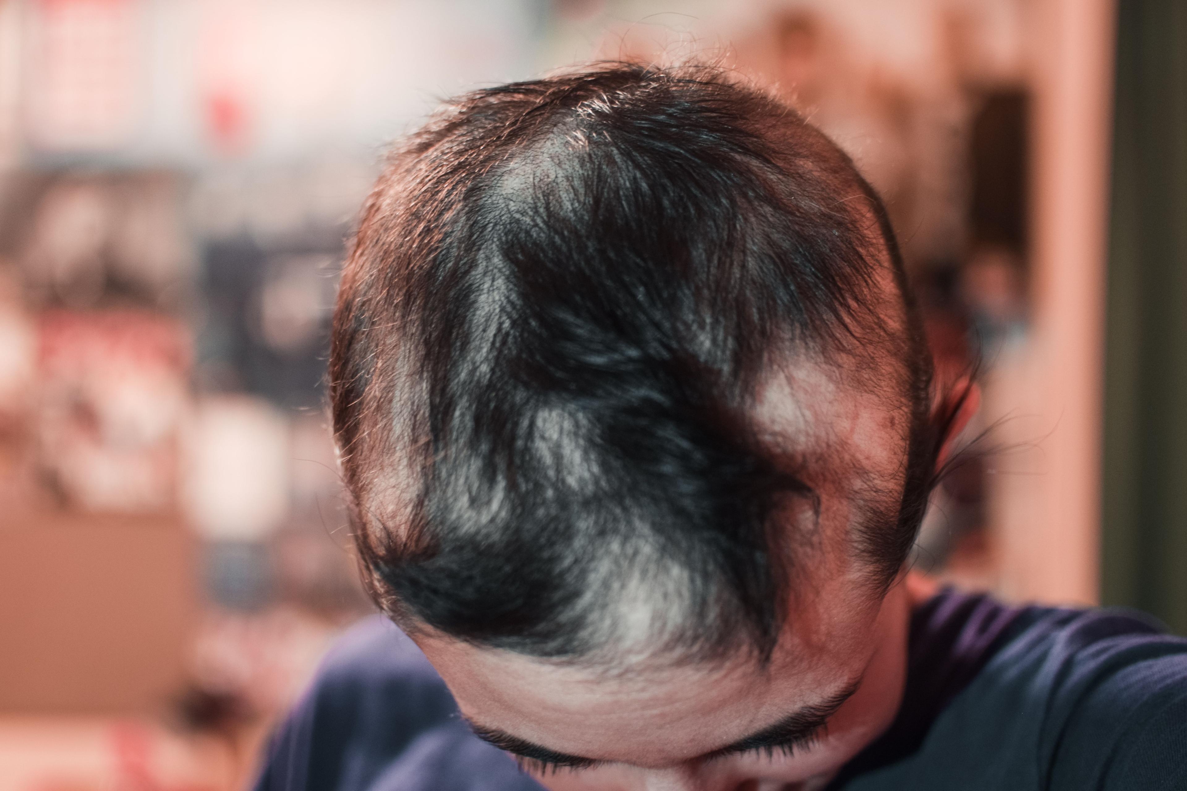 Alopecia Areata After COVID-19 Vaccines: Clinical Insights