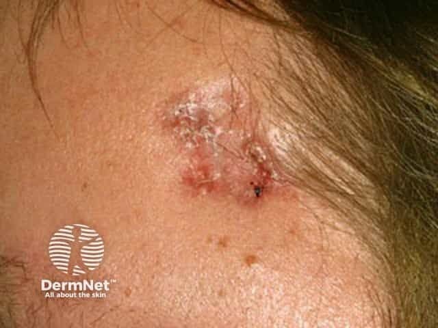 Basal cell carcinoma affecting the face