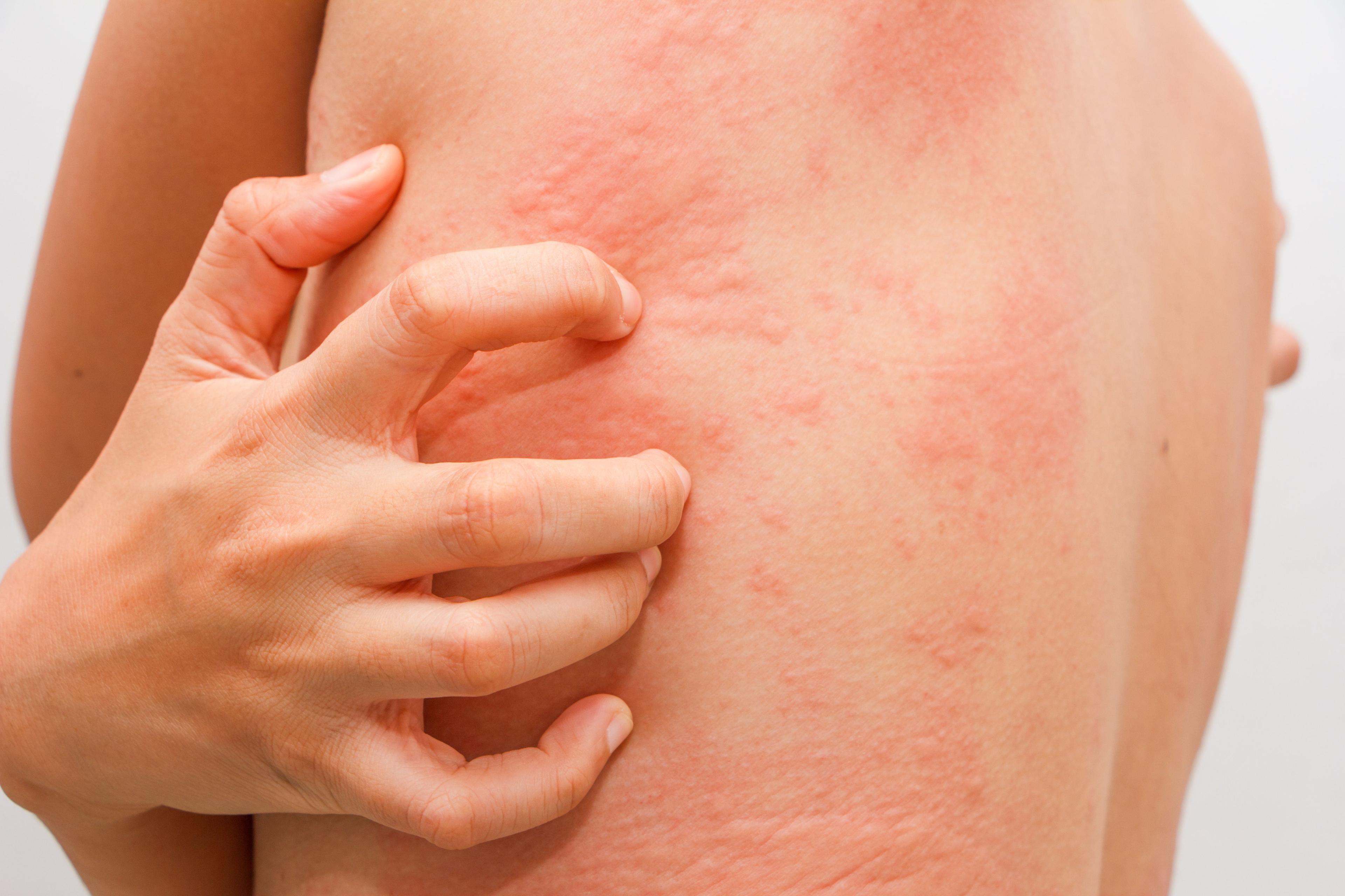 1 in 5 With Spontaneous Urticaria Has Celiac Disease Autoantigen Expression