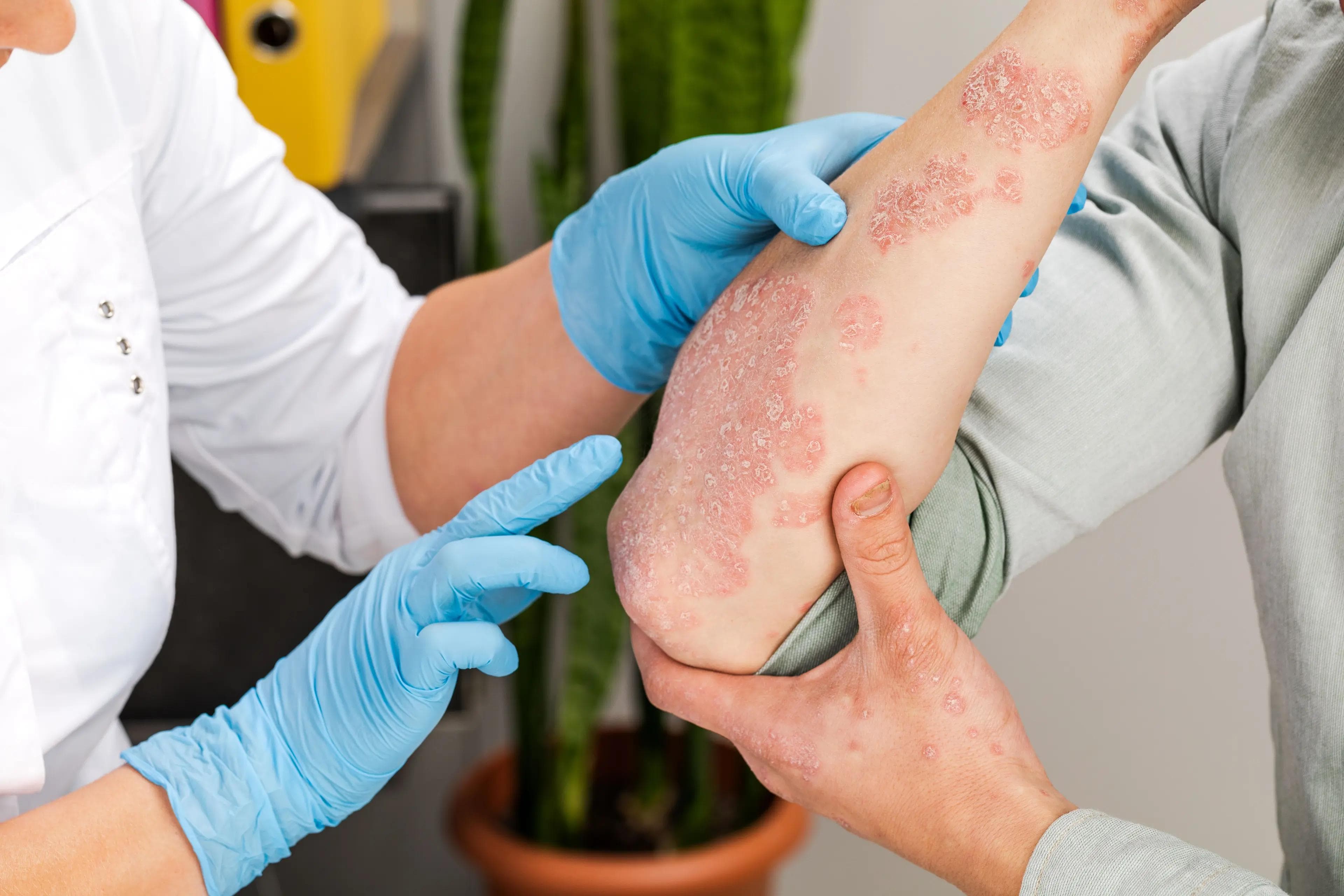 Patients with atopic dermatitis flares experience worsening signs and symptoms of the disease and require intensification of treatment.  | Image credit: fusssergei - stock.adobe.com