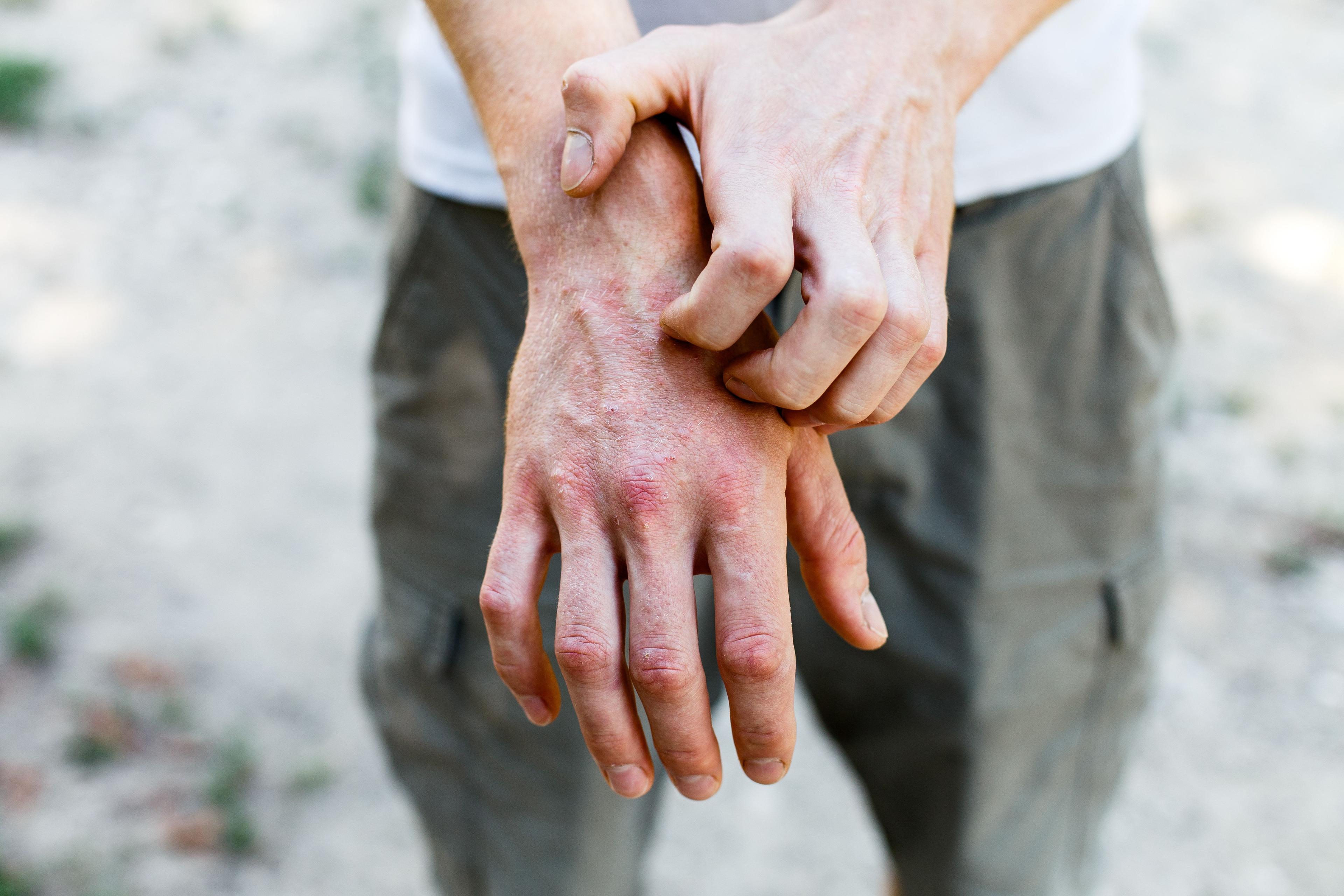 Patient with atopic dermatitis on hands | Image Credit: ©Ольга Тернавская - stock.adobe.com