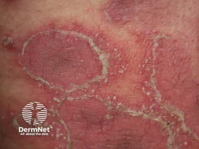 Generalized pustular psoriasis