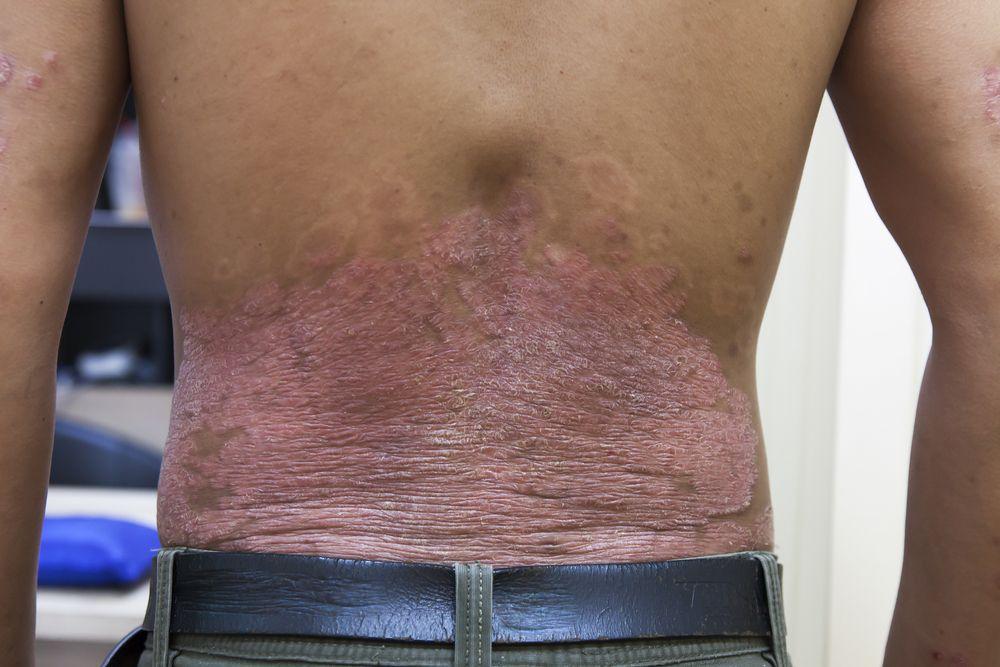 psoriasis