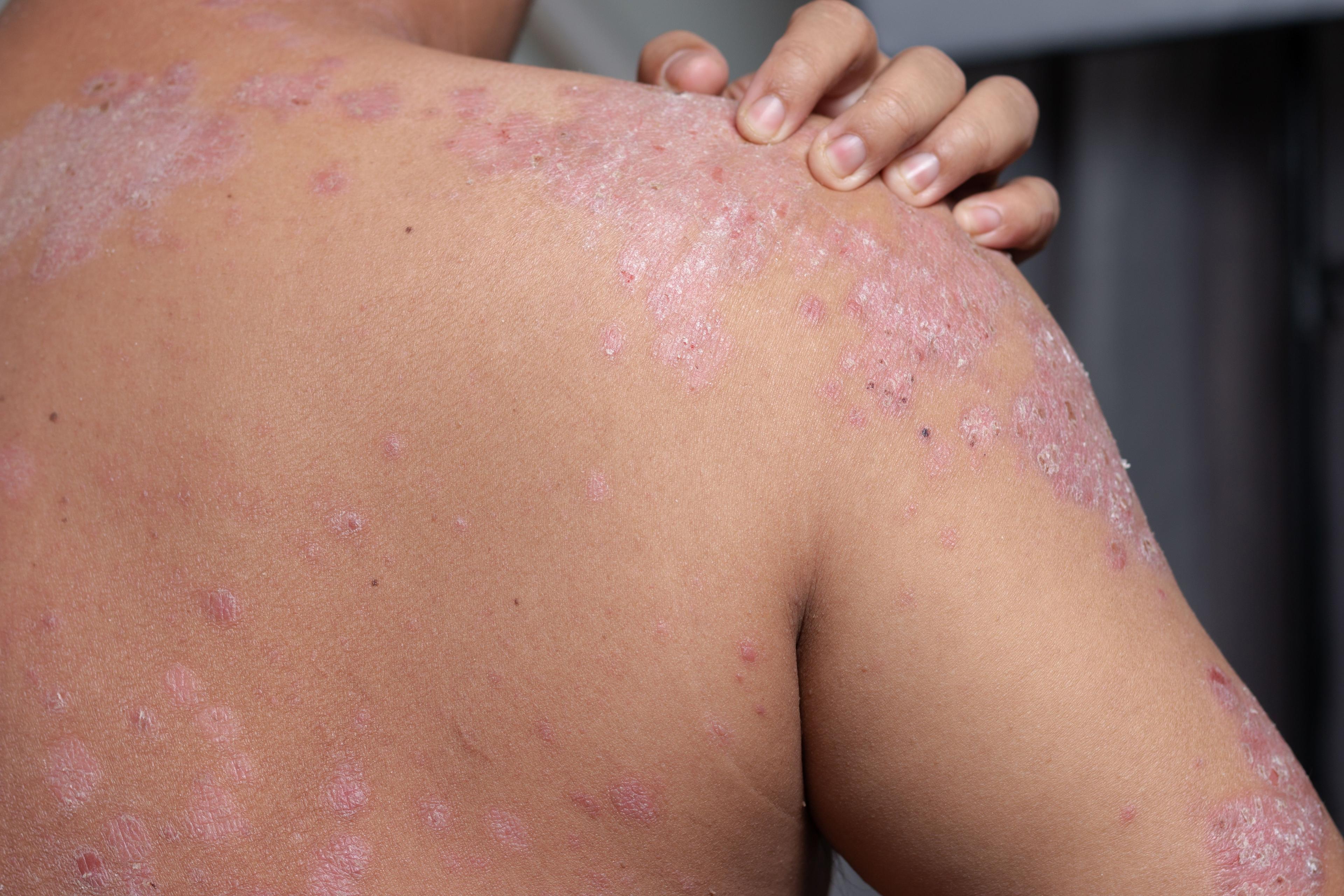 Psoriasis Does Not Increase Risk of COPD, According to New Study