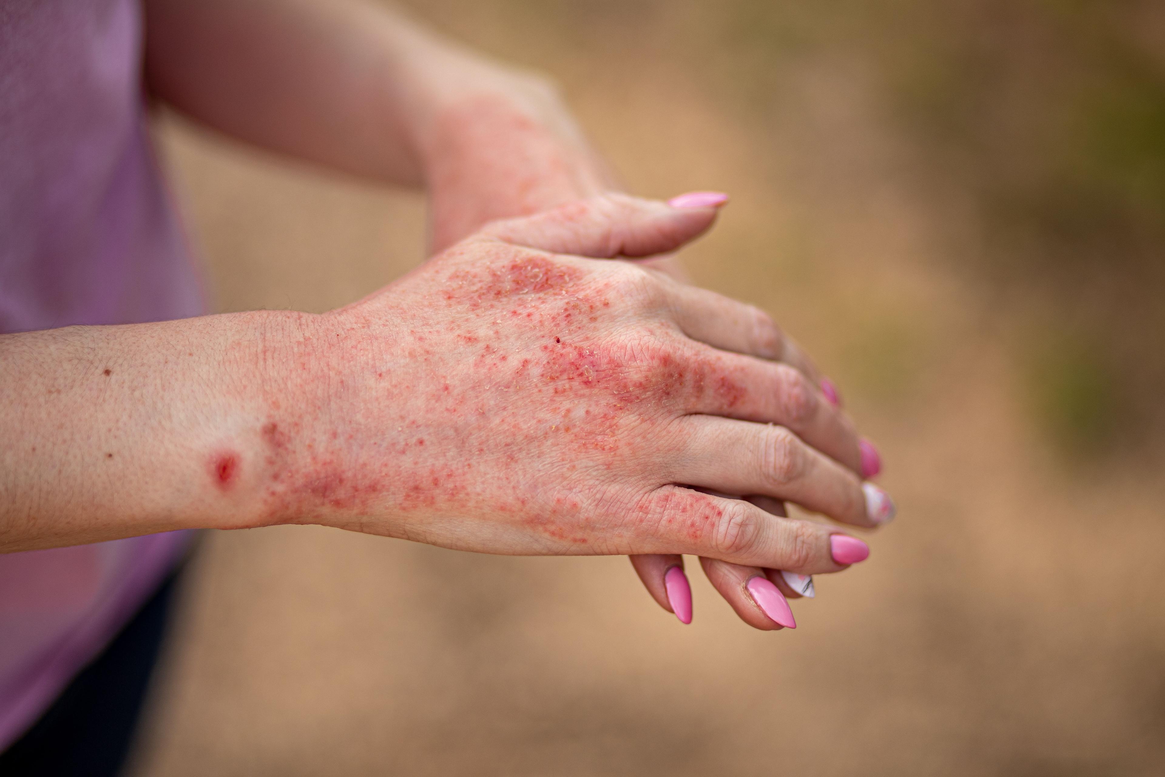 Patient with hand dermatitis | Image Credit: © InfiniteStudio - stock.adobe.com