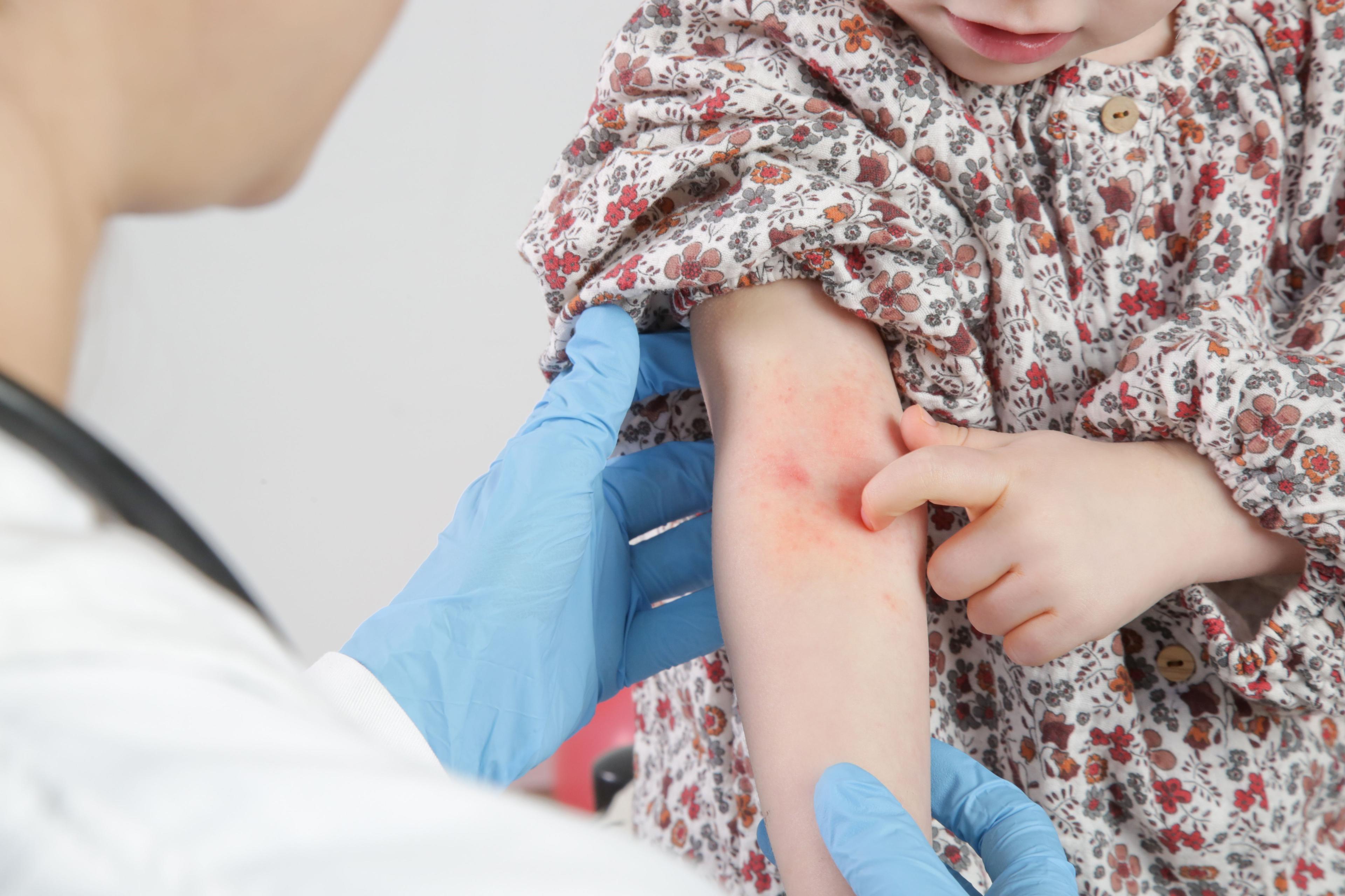 Doctor looking at red skin lesions on young girl's inner arm