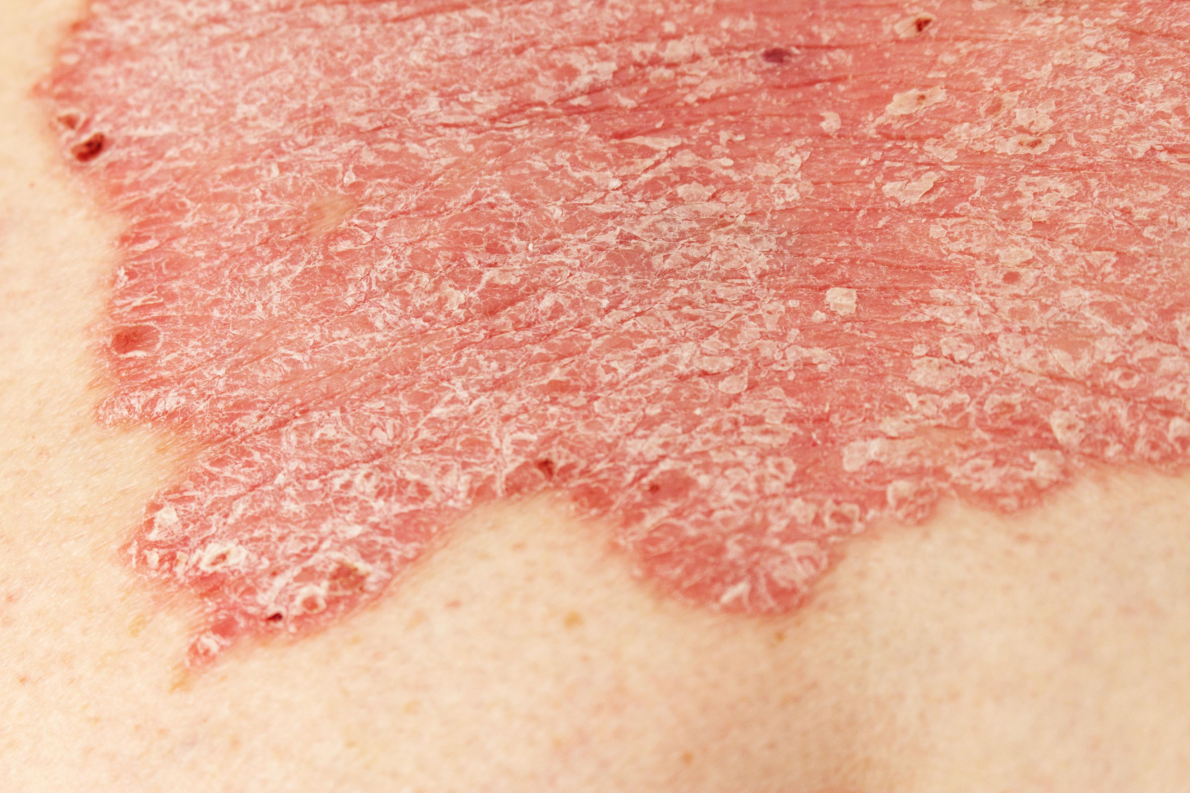 Close-up view of psoriasis on the skin