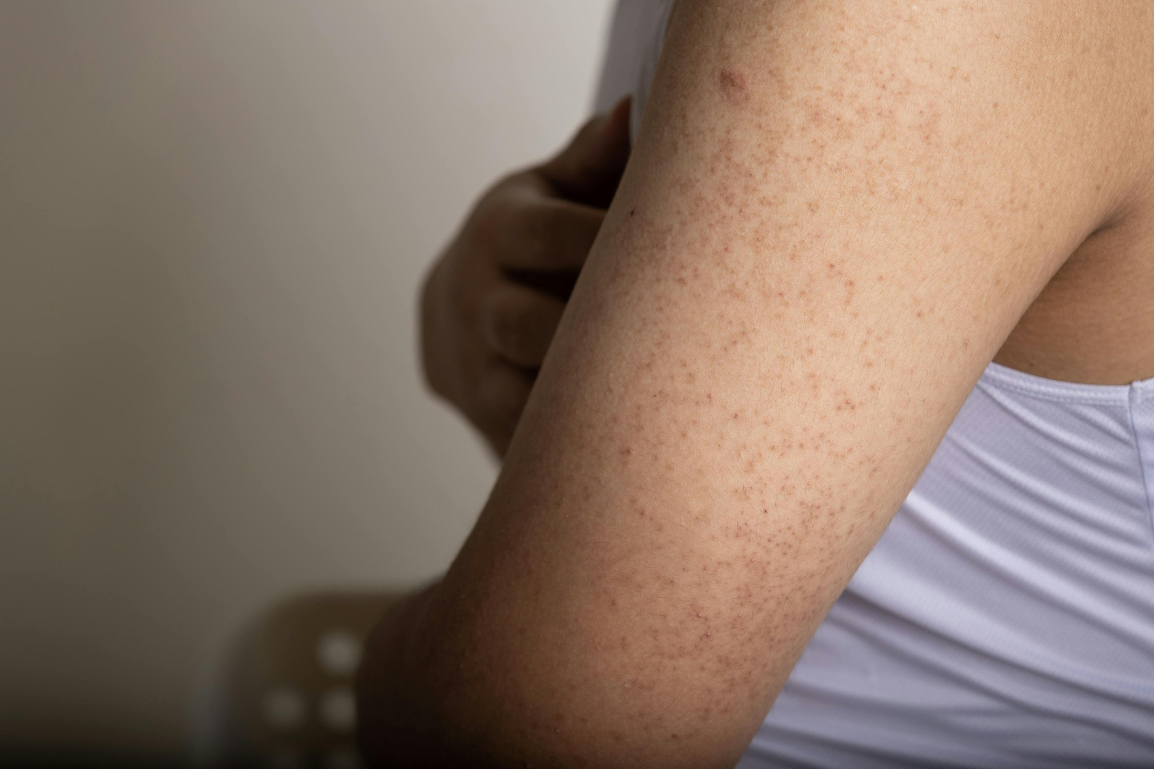 Keratosis pilaris