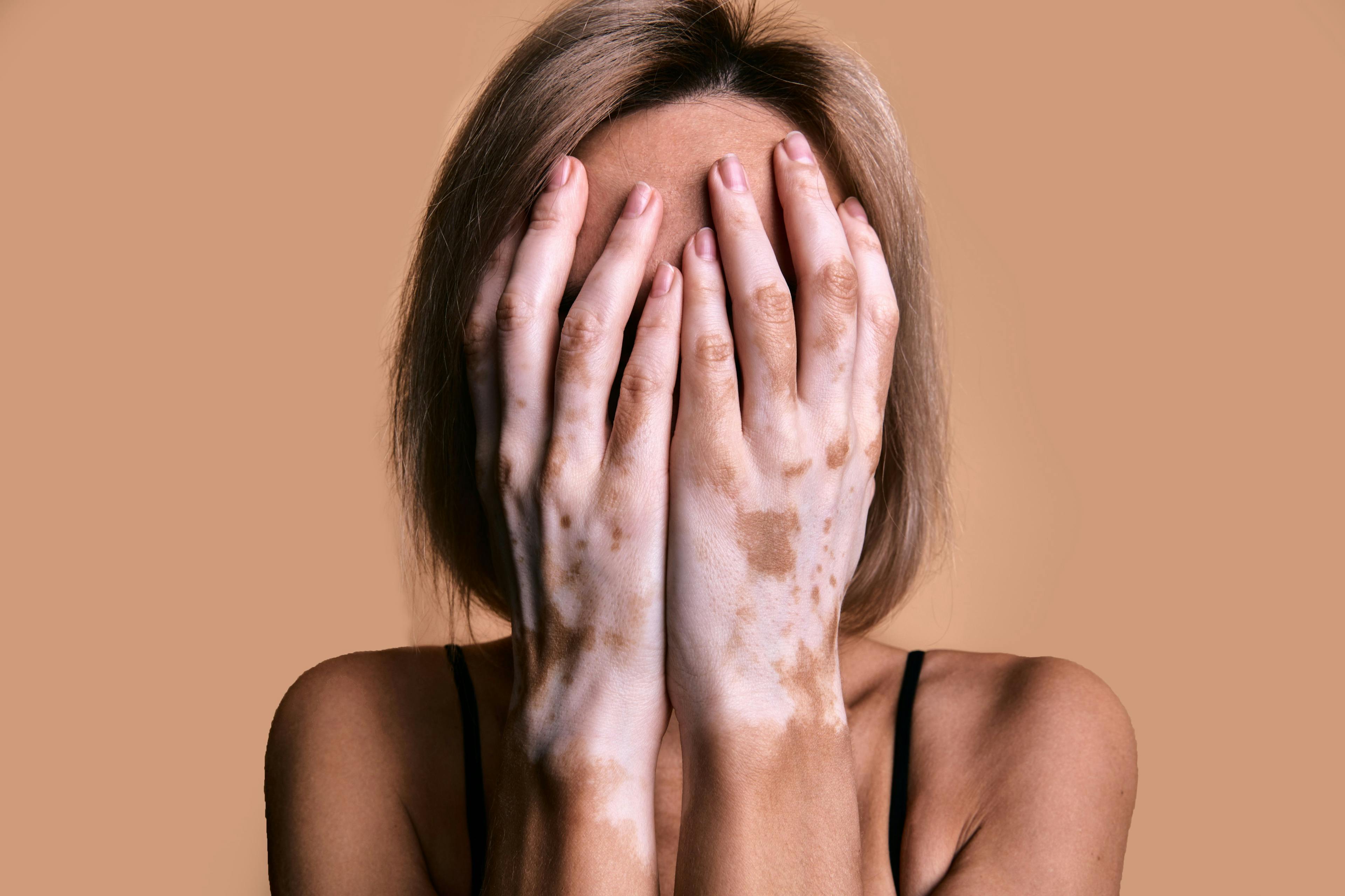 Woman with vitiligo | Image Credit: © Savory