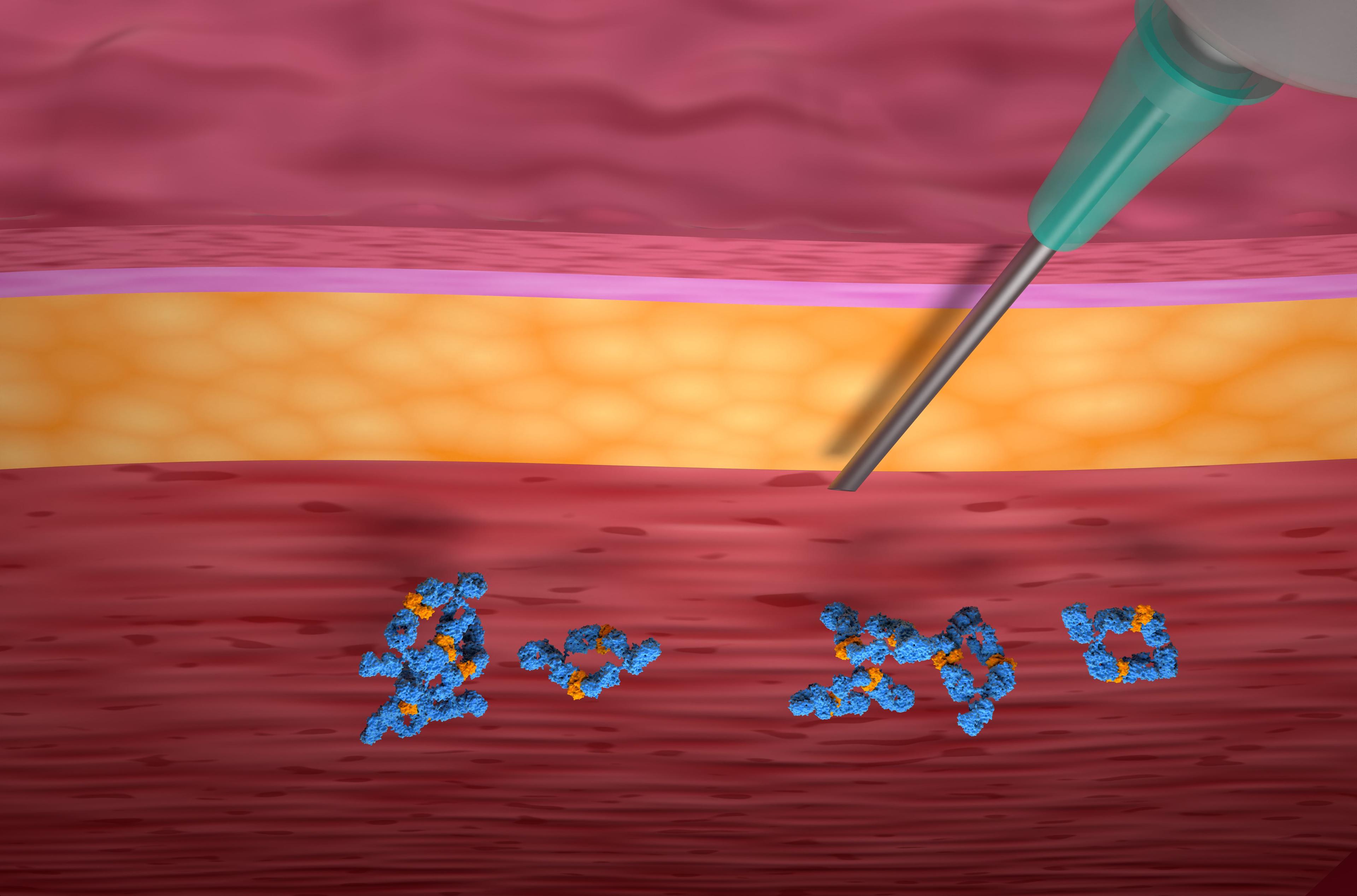 Systemic hidradenitis suppurativa treatment illustration | Image Credit: © LASZLO - stock.adobe.com