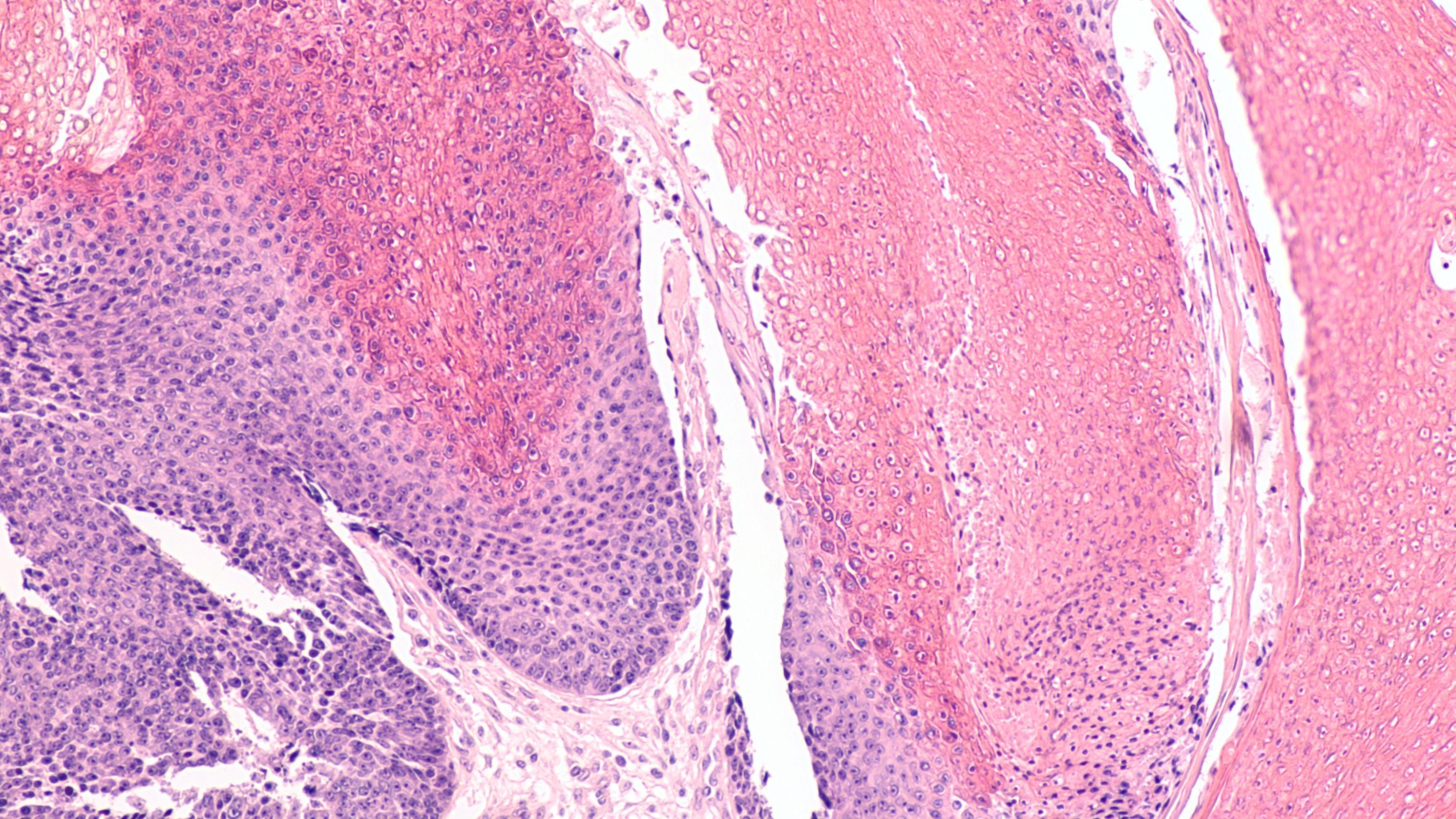 Subcutaneous Nodules Misdiagnosed as Pilomatricoma