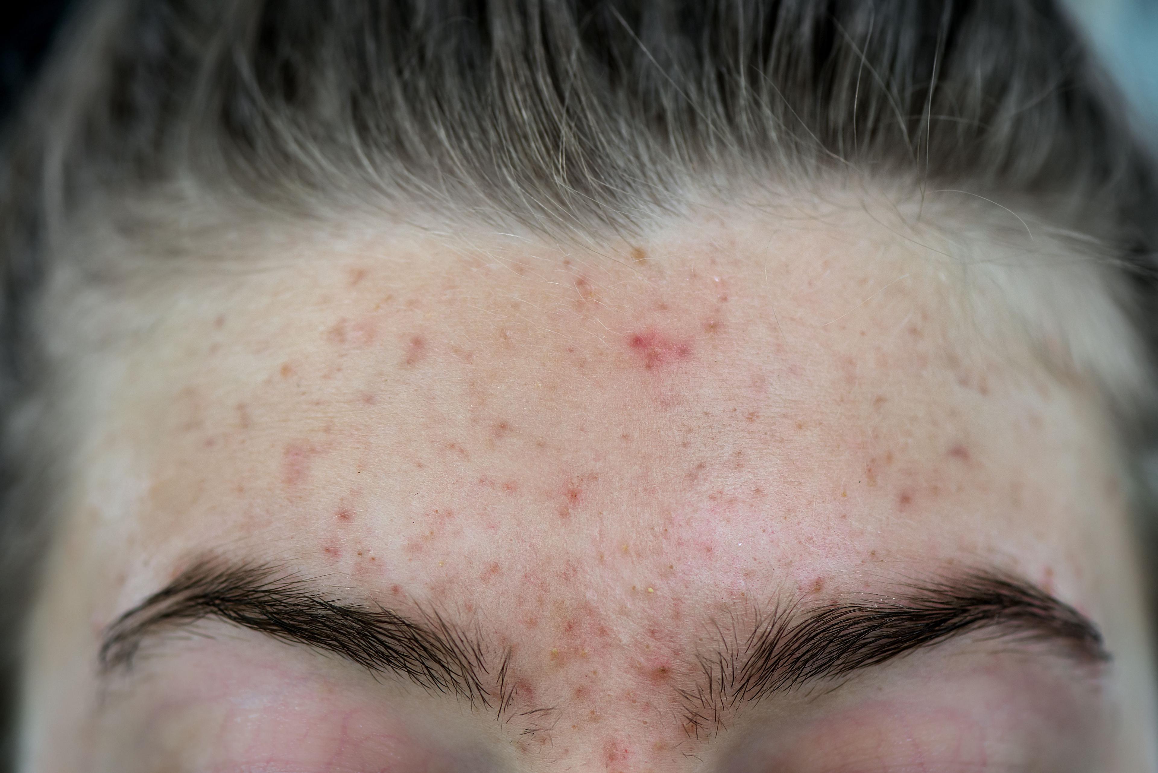 Tranexamic Acid Injections May Be Efficacious in Acne Vulgaris