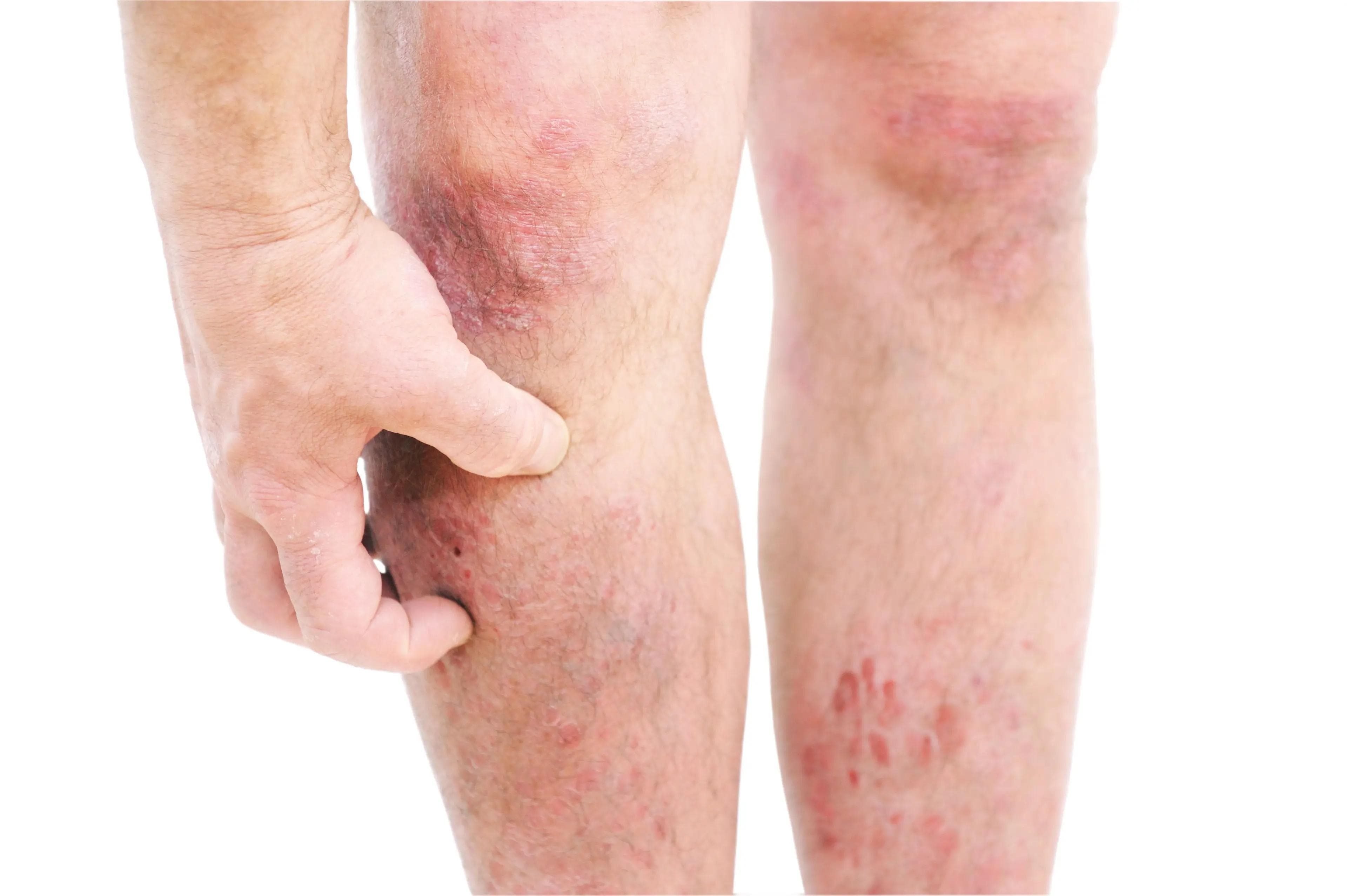 Atopic dermatitis on the knees and legs