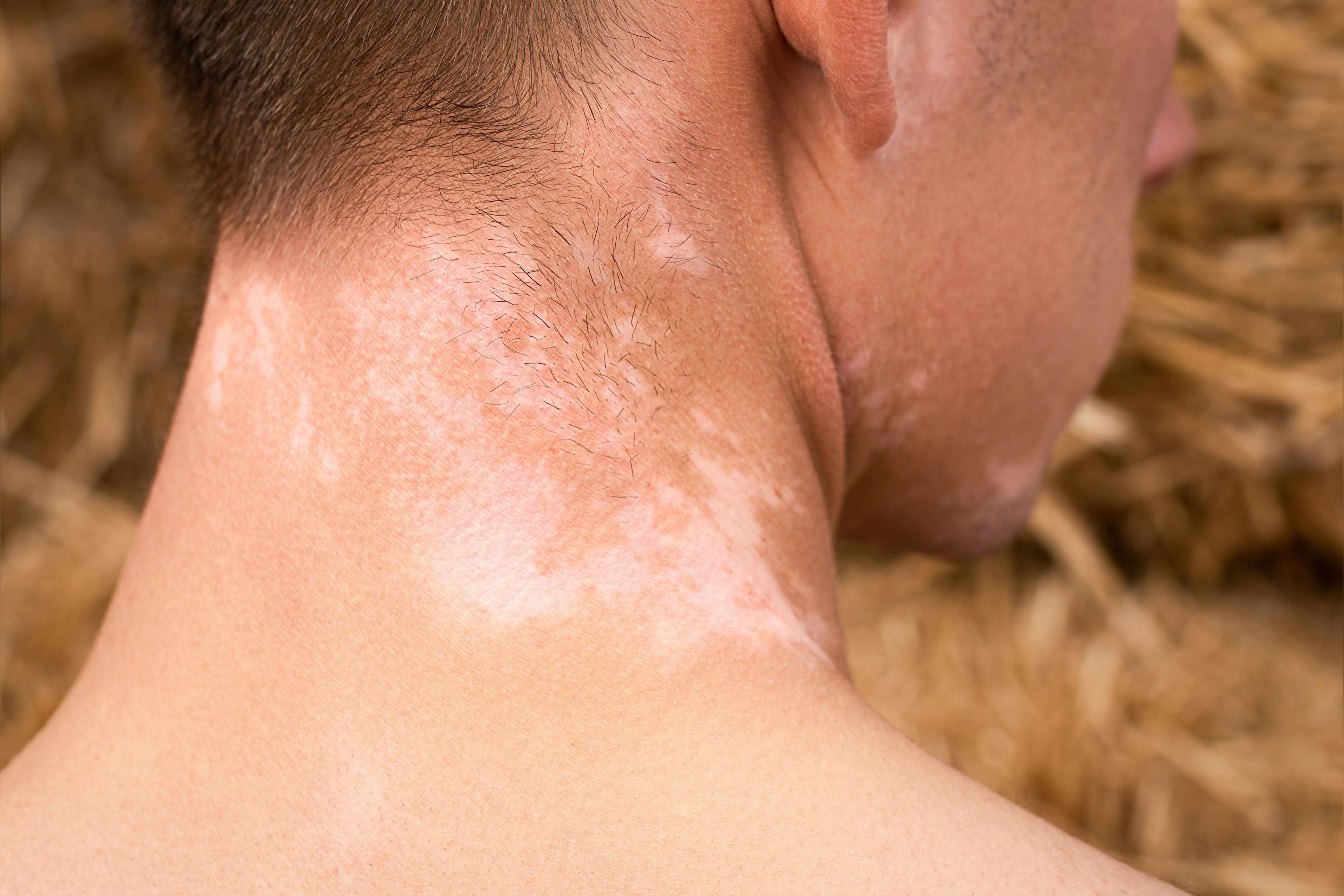 Vitiligo on the skin of the neck of a man