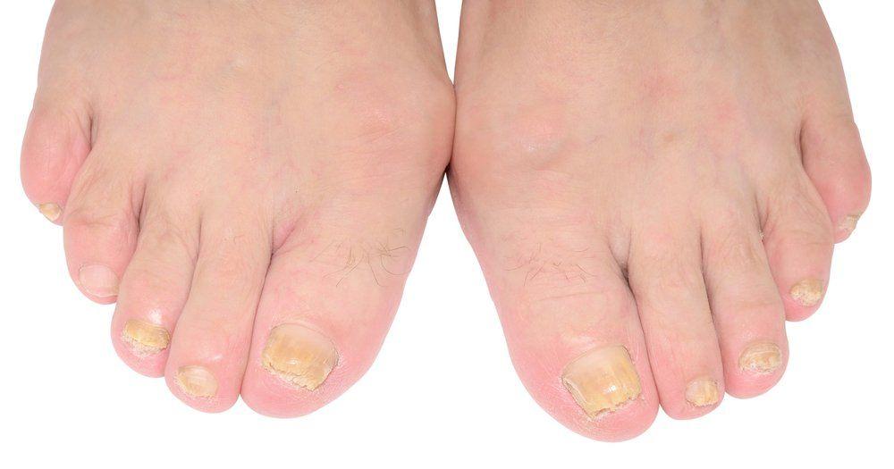 nail fungus