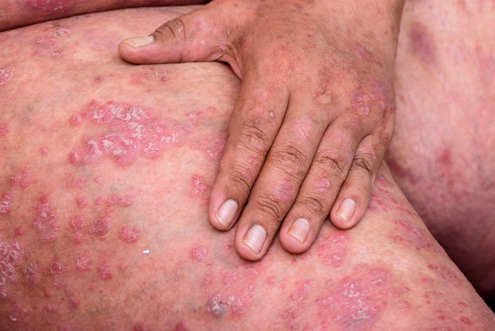 psoriasis