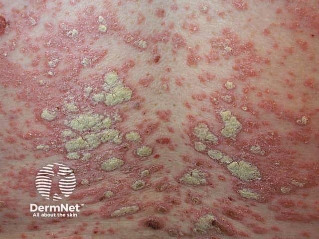 Chronic plaque psoriasis | Image credit: DermNet