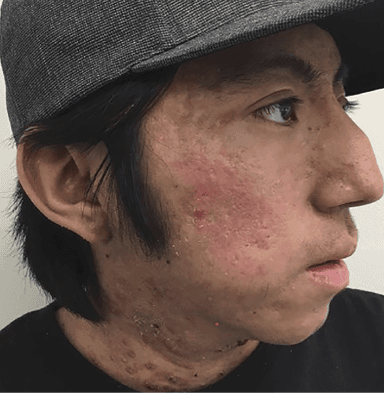 Patient 3 months S/P pseudo acne fulminans diagnosis