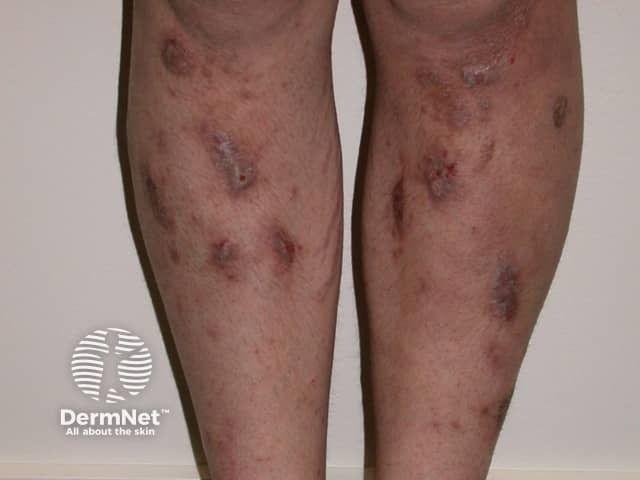 Approximately 65% of Dermatologists in Japan Report Dissatisfaction With Treatment Options for Severe Prurigo Nodularis