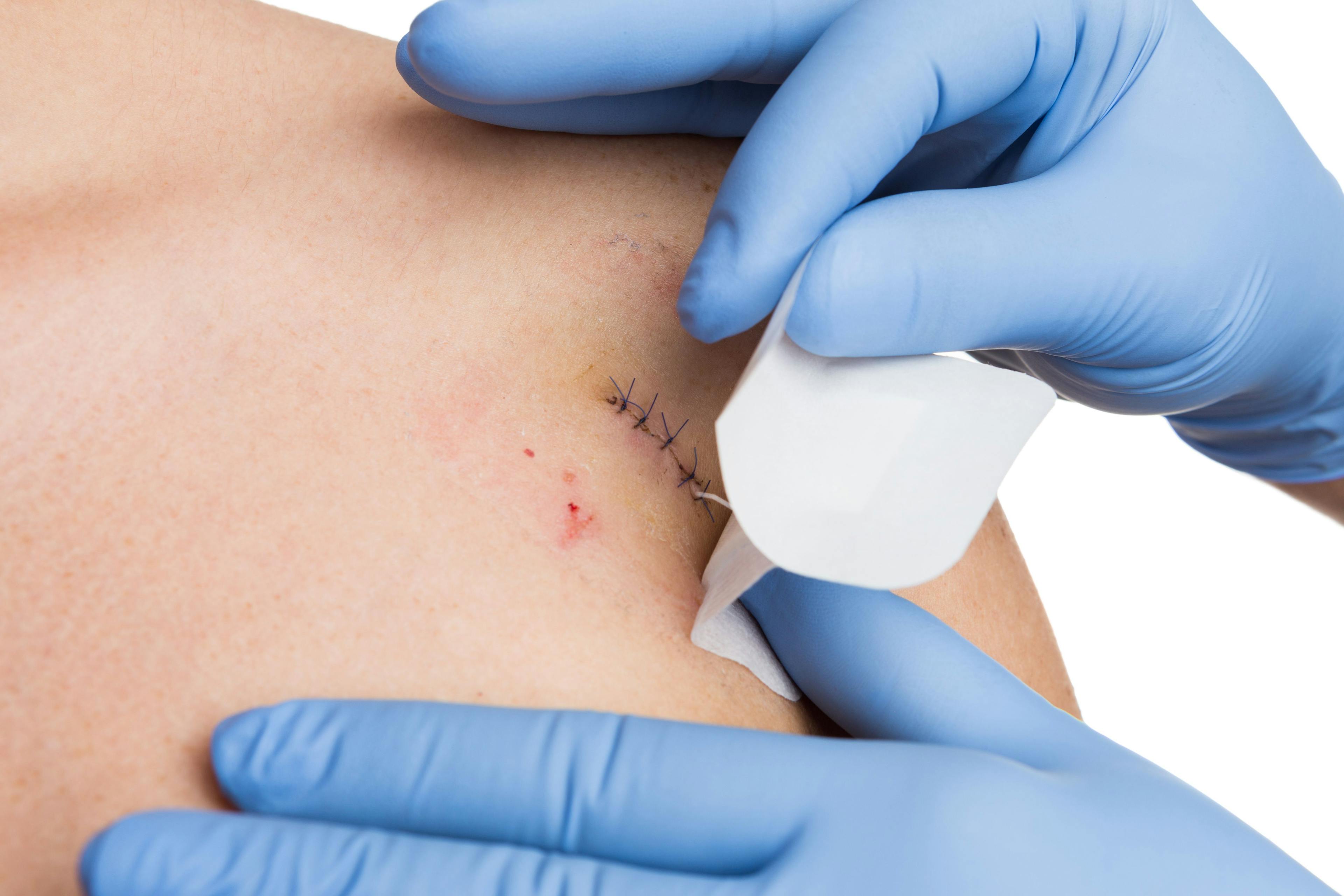 Doctor's hands covering wound after mole removal