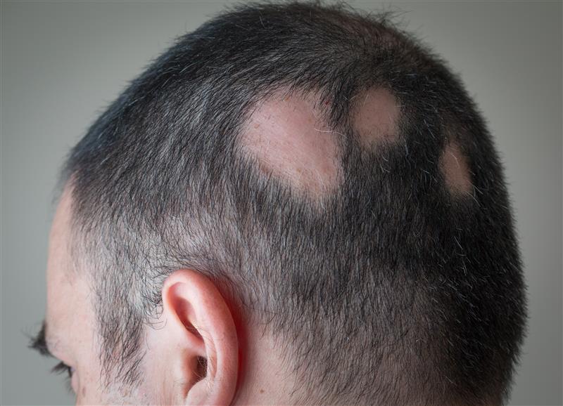 Cetirizine 1% Cream for Androgenetic Alopecia