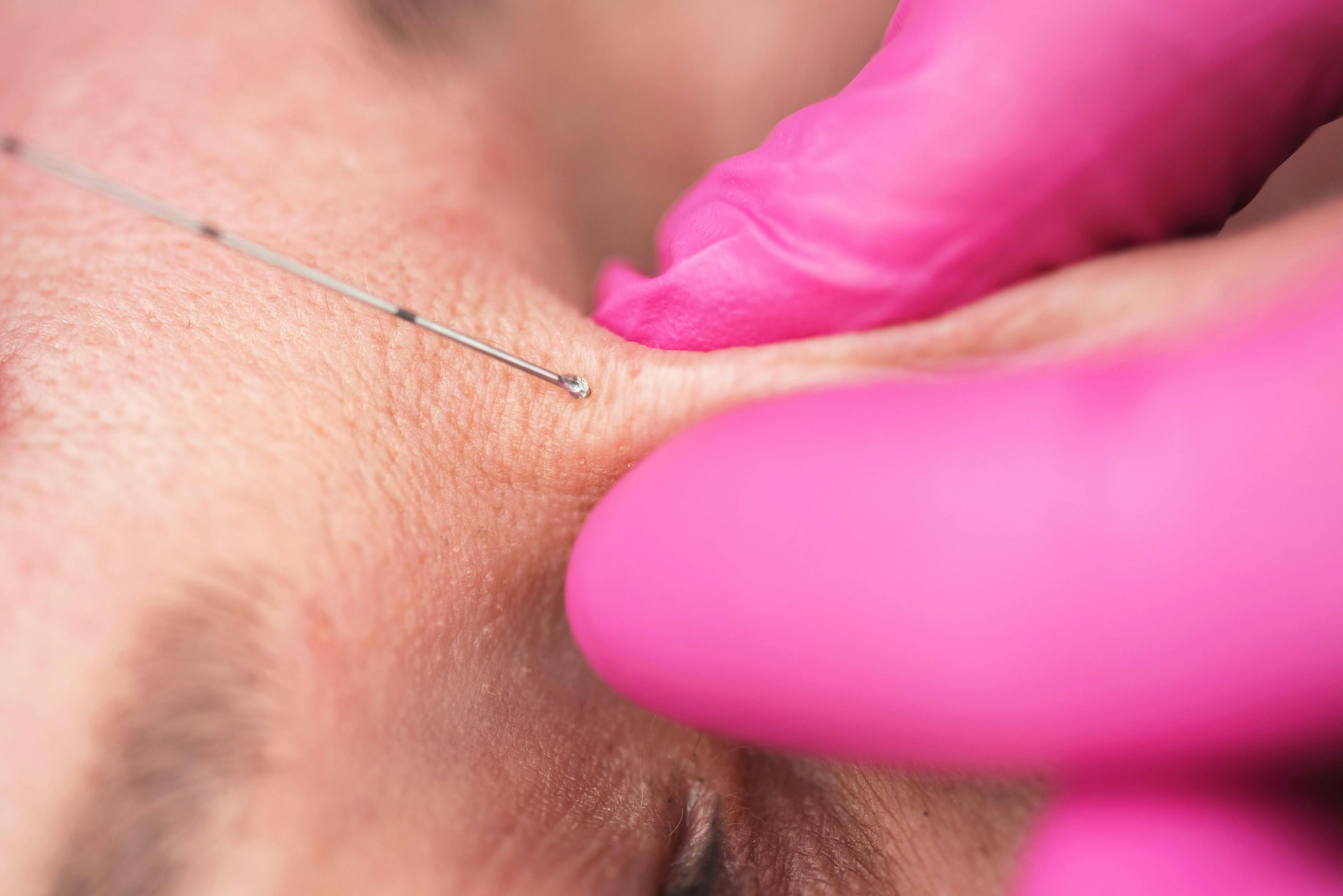 Close up image of dermal filler to be injected at the top of the nose