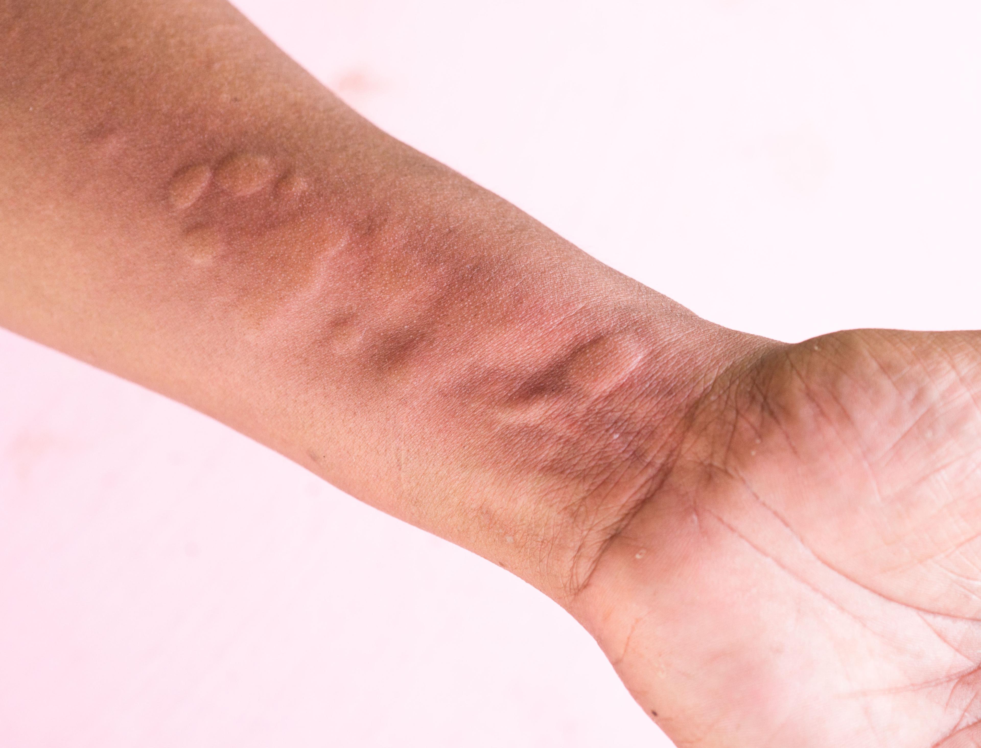 A Deep Dive Into the Chronic Spontaneous Urticaria Armamentarium