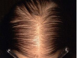Overview of woman with pattern hair loss