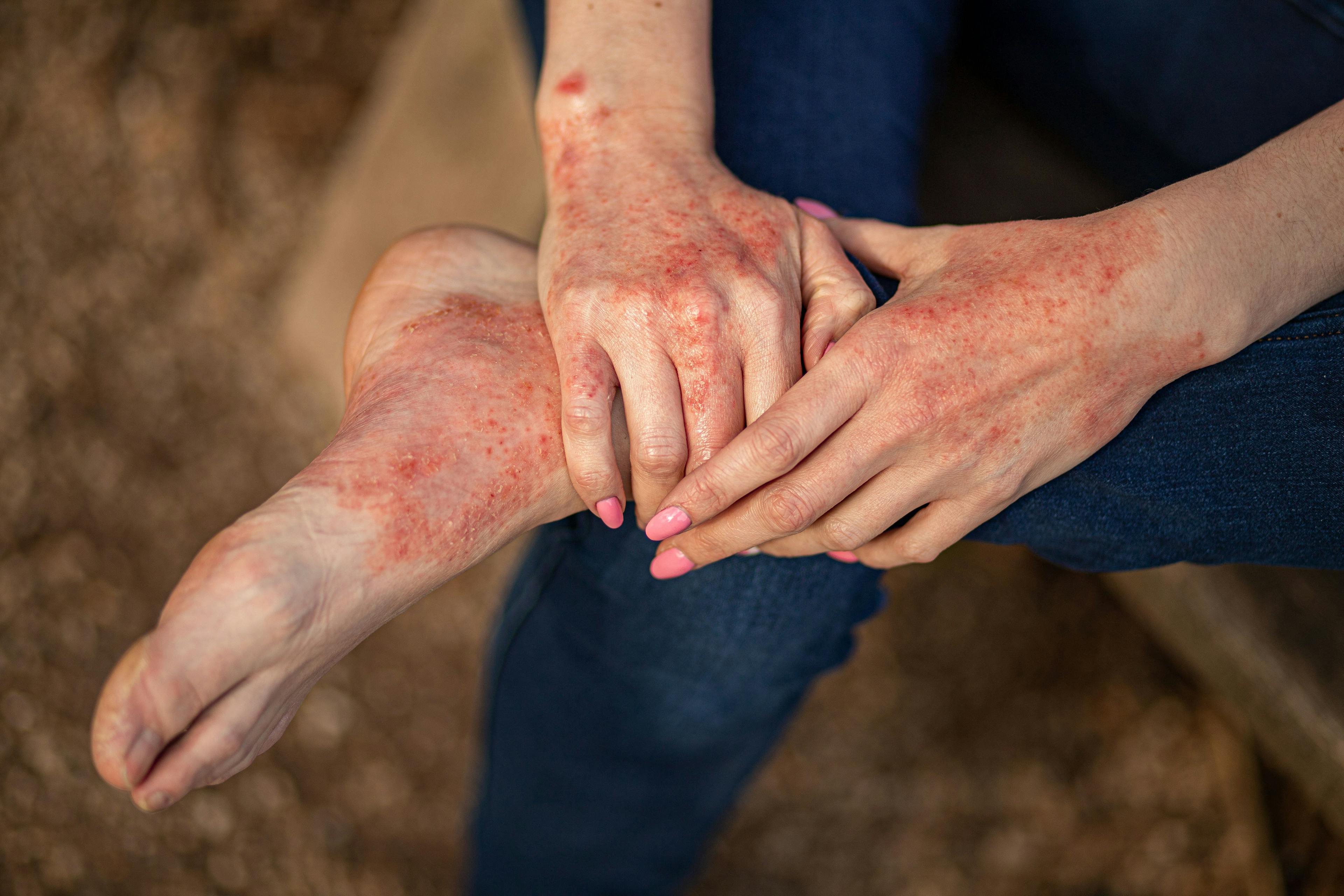 Atopic dermatitis on hands and feet | Image Credit: © InfiniteStudio - stock.adobe.com