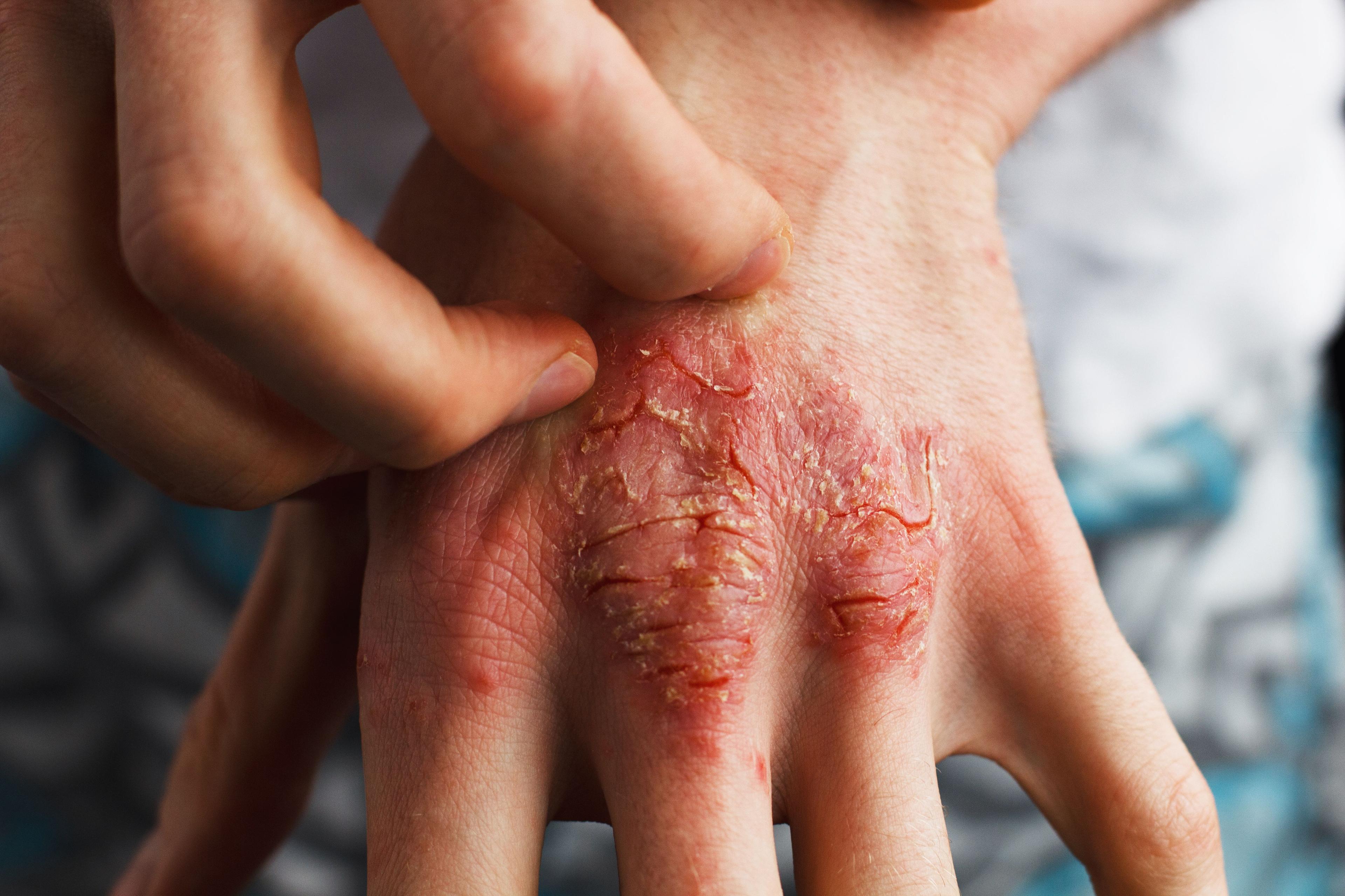 Patient with plaque psoriasis on hands | Image Credit: © Ольга Тернавская - stock.adobe.com