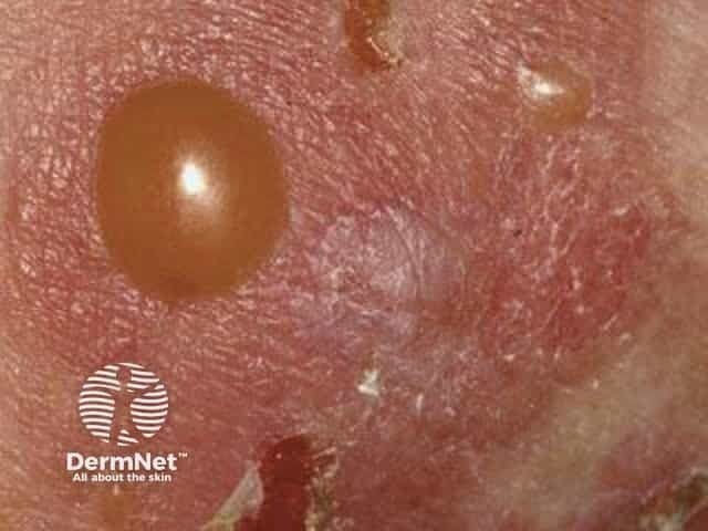 Bullous pemphigoid