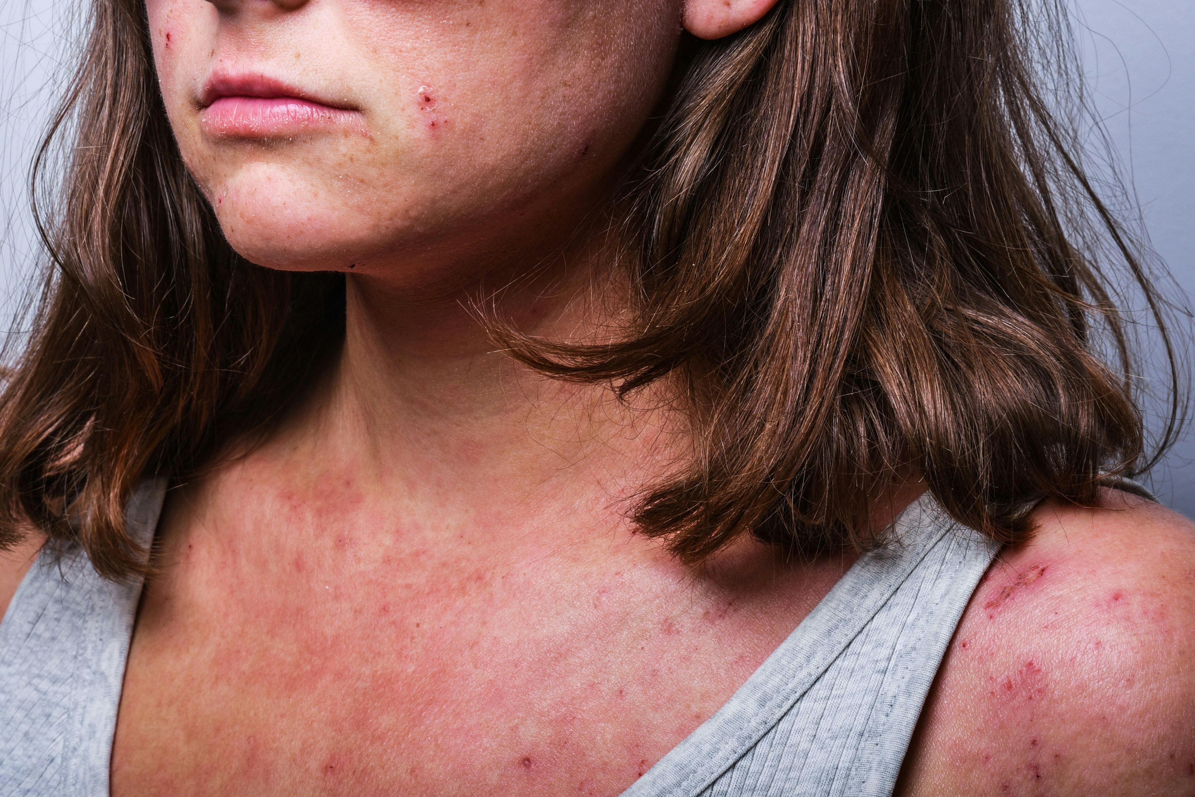 Woman with Atopic Dermatitis | Image Credit: © Ksenia Kirillovykh