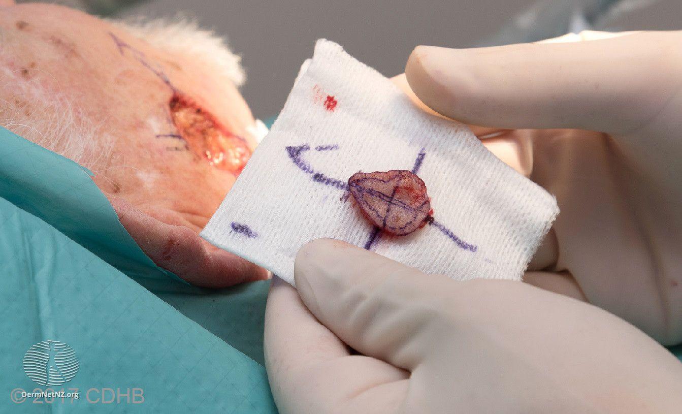 Mohs excision: Excision of visible tumour while maintaining orientation

Image courtesy of DermNet