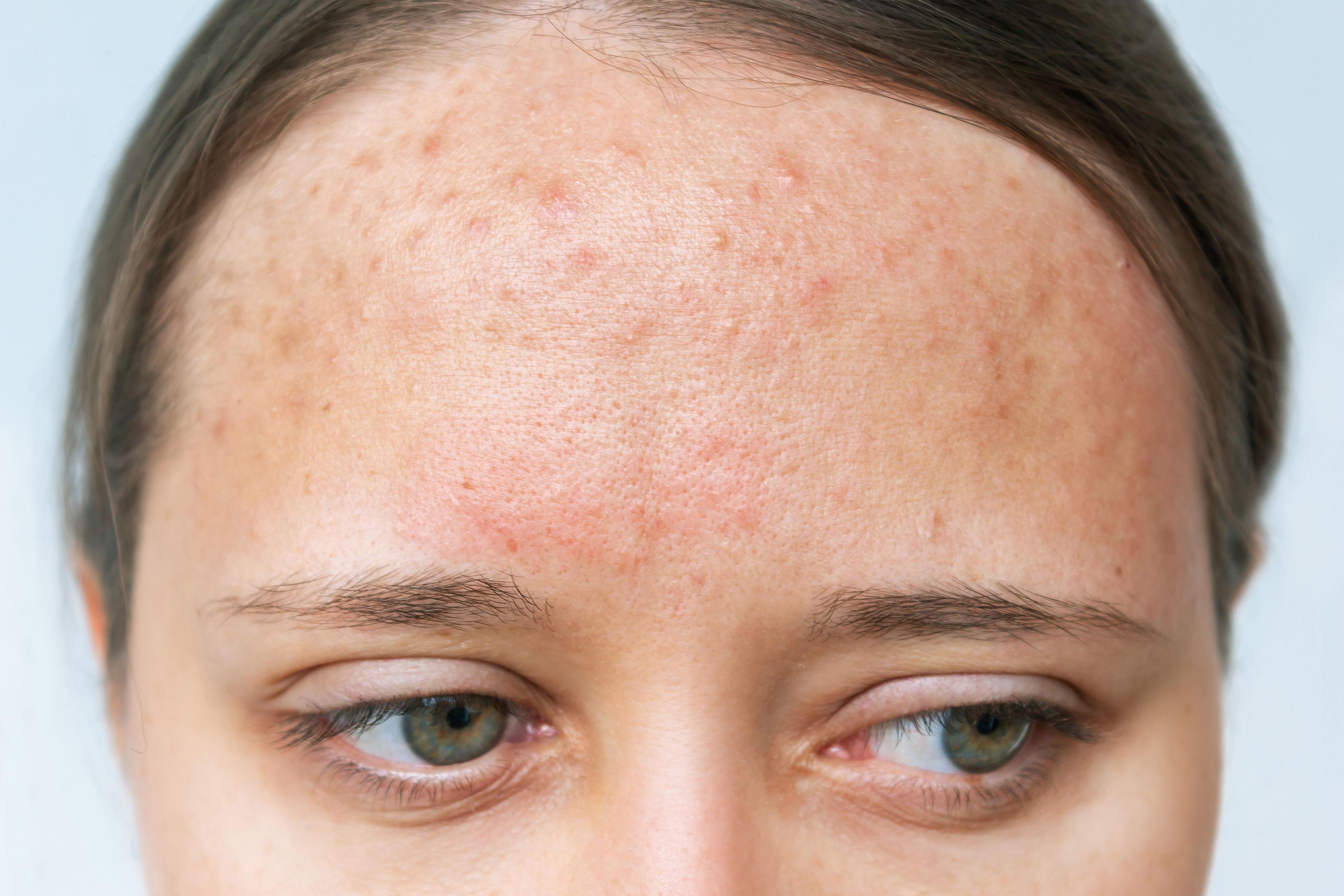 Close up of a young girl with acne on the forehead