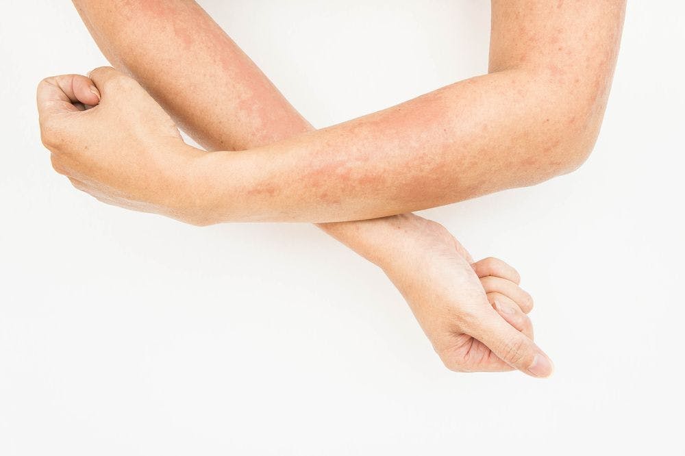 atopic dermatitis on arms