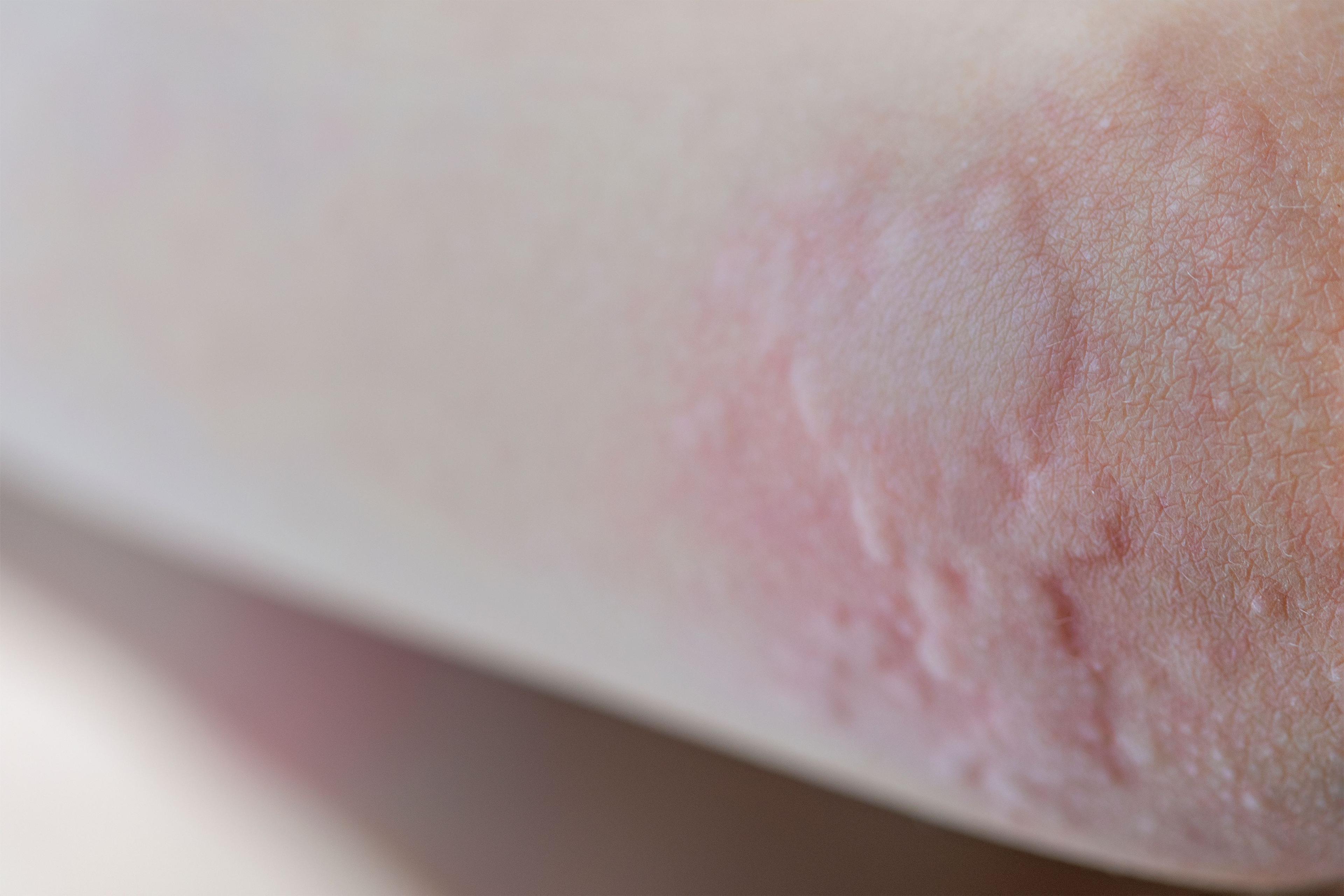 Patient with urticaria | Image Credit: © SERSOLL - stock.adobe.com