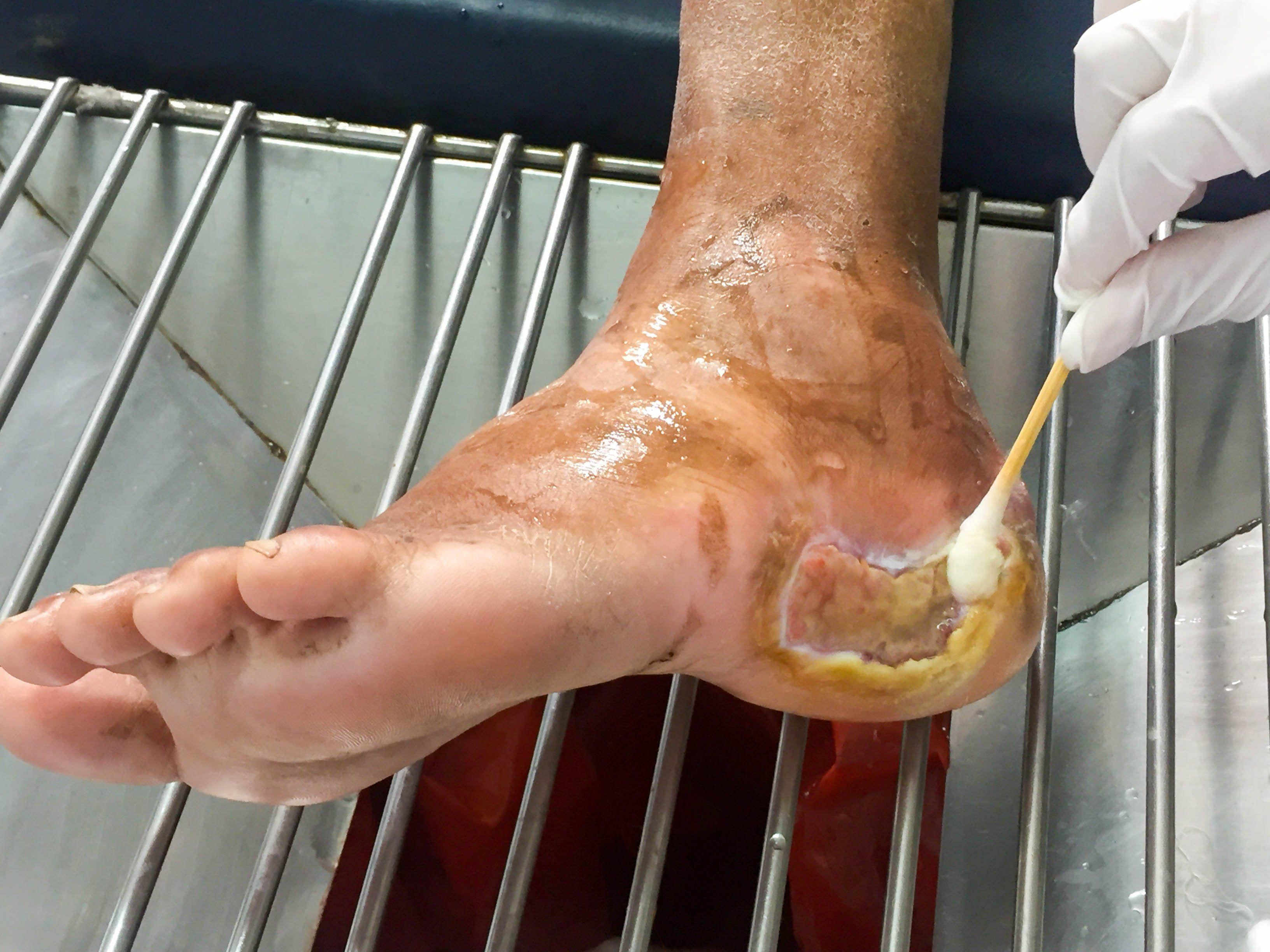 Diabetic Foot Ulcer