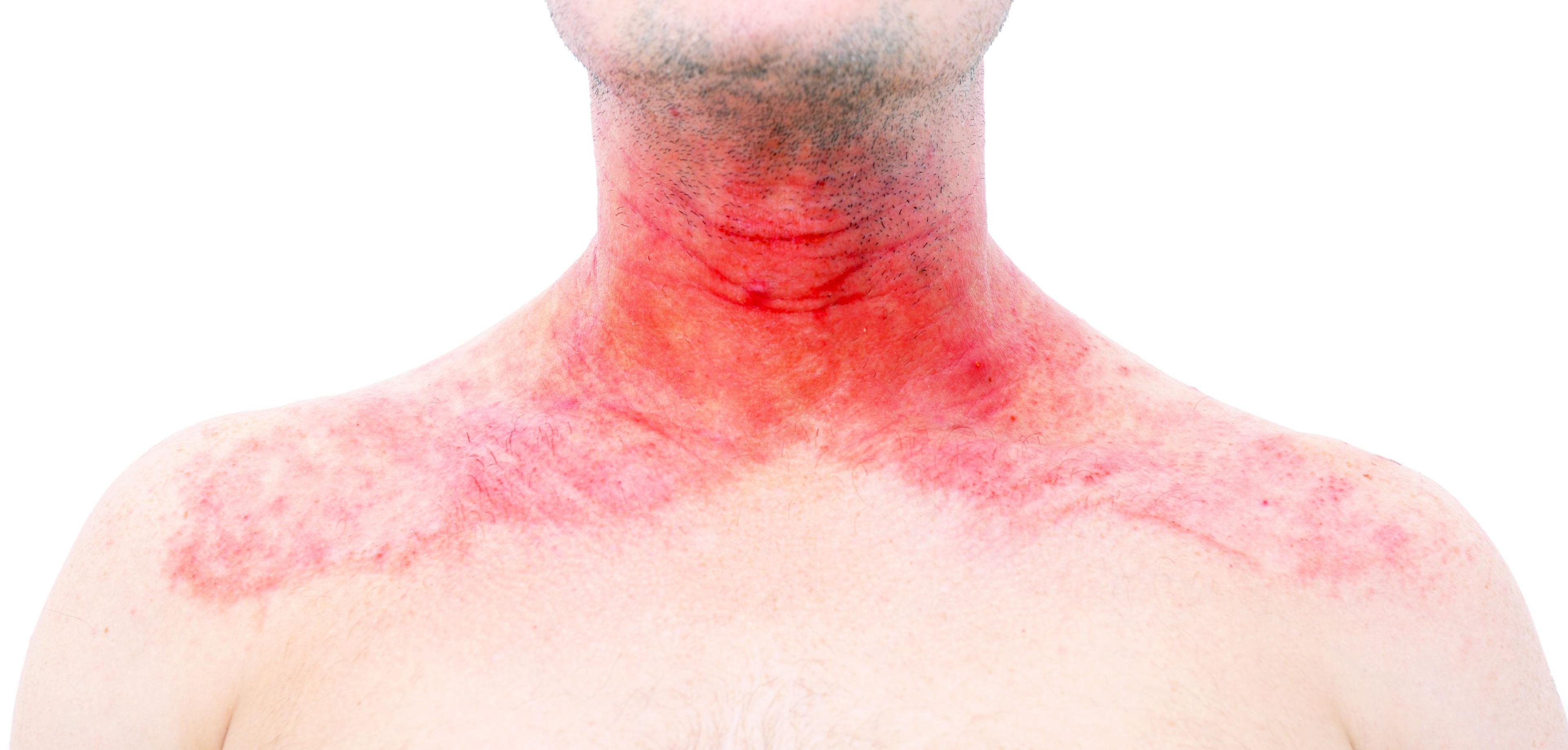 Atopic dermatitis/eczema on the neck