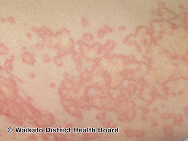 Spontaneous urticaria

Image courtesy of DermNet