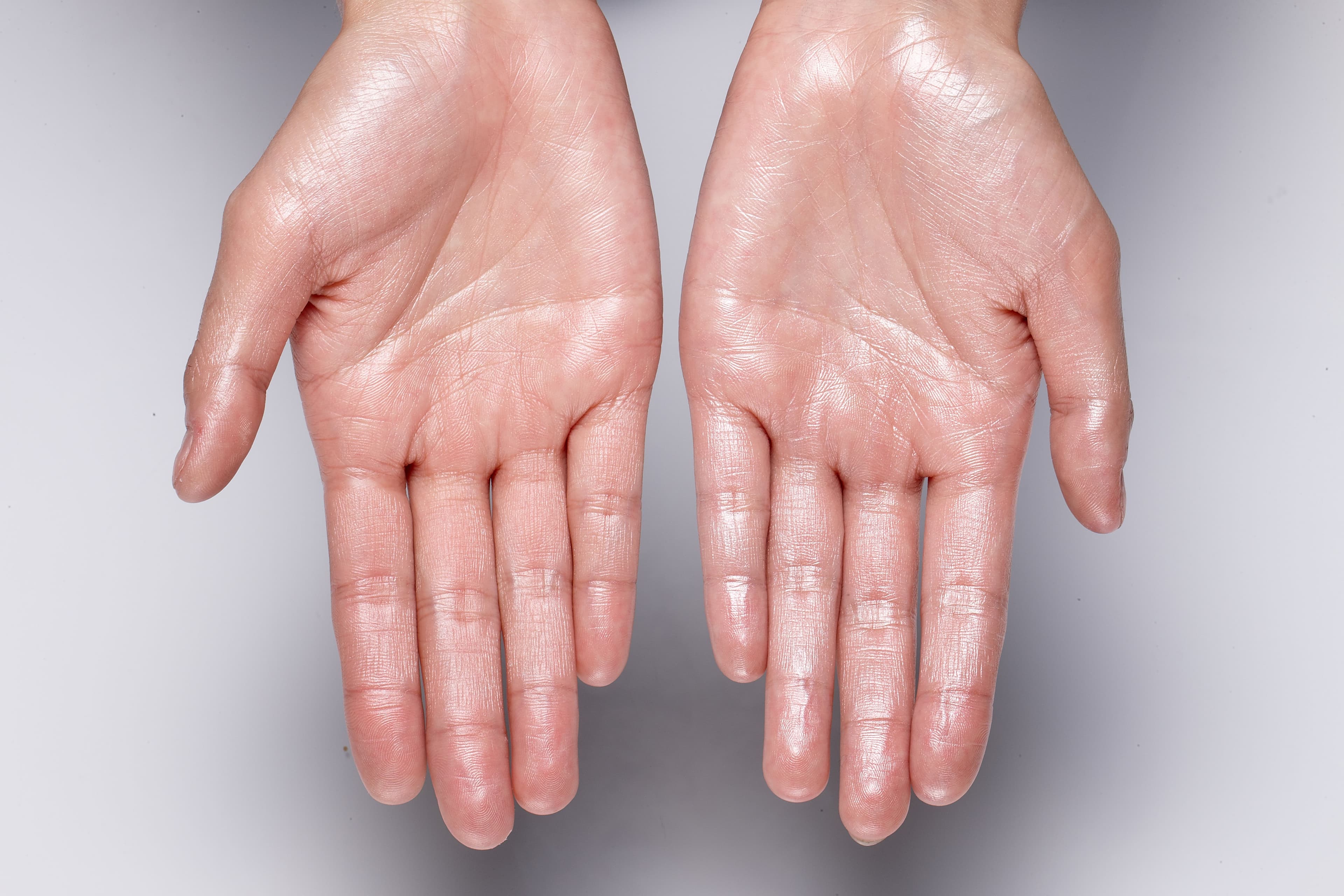 patient with hyperhidrosis on hands | Image Credit: © JOE - stock.adobe.com