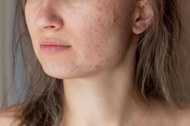 Highly Prevalent, Scarcely Supported: Common Skin Issues Remain Underserved 