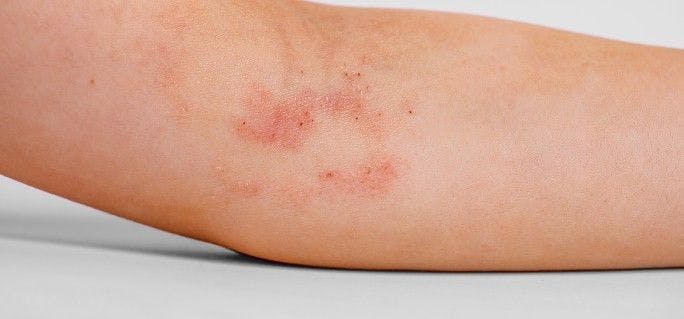 atopic dermatitis on the child's arm