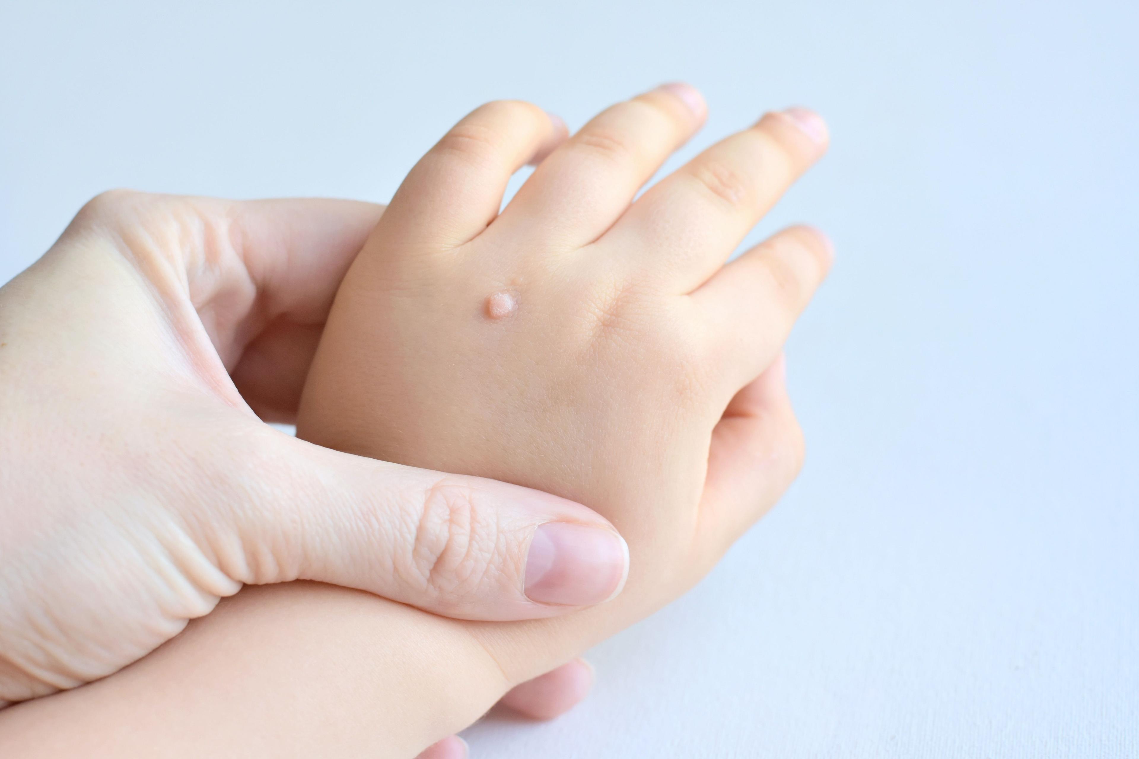 Child with a wart on the back of the hand