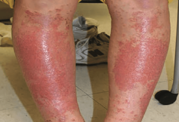 A Case of Shin Guard Dermatitis?